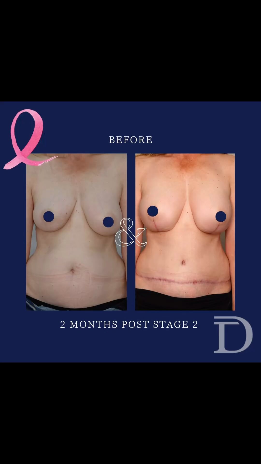 Bilateral Nipple Sparing Mastectomy + Immediate DIEP Breast Reconstruction 
1. Pre Op 
2. 2 Months Post Stage 2
- Surgery 1 - Bilateral Nipple Sparing Mastectomy + SLNB performed by Breast Surgeon + Immediate DIEP Breast Redconstruction. When keeping the nipple, a small paddle of skin from the abdomen remains attached under the nipple, to monitor the free tissue transfer. 
- Surgery 2 (minimum 3-4 months post) - monitoring skin paddle removed + bilateral breast fat grafting to smooth out contour on breasts/ abdomen 
- Scars take 12-18 months to mature/ fade 
Surgery Performed by Dr Duncan Taylor (MED0001883464) Specialist Plastic & Reconstructive Surgeon.
🔹 Outcomes achieved in these photos are only relevant to this patient and do not necessarily reflect the results other patients may experience.
🔹There are inherent risks associated with any surgical or invasive procedures. The recovery period varies based on the specific procedure, and individual outcomes will differ.
🔹More information about risks and recovery for each procedure is available on our website www.drduncantaylor.com.au, on the procedure information sheets.
🔹We recommend getting a second opinion from a qualified health practitioner before proceeding.
🔹 This patient gave photo consent. 
#autologousbreastreconstruction #diepbreastreconstruction #diepsurgery #bilateraldiep #bilateralmastectomy #bilateralmastectomywithreconstruction #nipplesparingmastectomy #immediatebreastreconstruction #breastreconstruction #breastreconstructionperth #perthbreastreconstruction #breastreconstructionawareness #breastcancerperth #specialistplasticsurgeon #perthplasticsurgeon #plasticsurgeonperth #perthbreastcancer