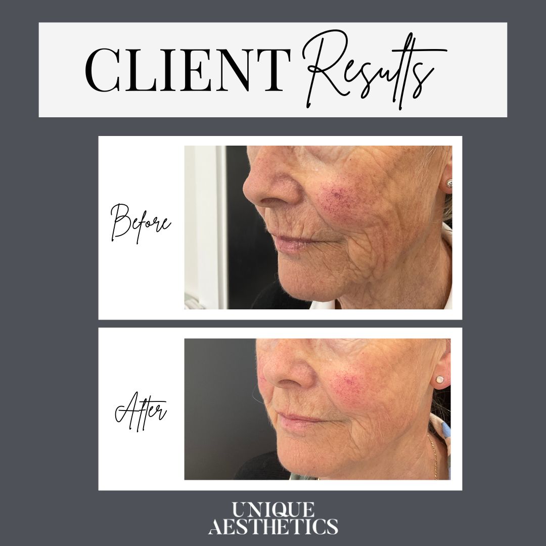 RADIESSEĀ® is made from calcium hydroxylapatite spheres. Vertically lifts for immediate volume correction.
Stimulates collagen to increase your skinās thickness and smooth texture. Results are natural and work with your own collagen to provide long lasting results. Radiesse Ā® injectable implant is intended for plastic and reconstructive surgery, including deep dermal and sub-dermal soft tissue augmentation of the facial area and dorsum of the hands.
Radiesse Ā® injectable implant is indicated for: the treatment of nasolabial folds, marionette lines or jawline; the augmentation of cheeks; the hand augmentation to correct volume loss in the dorsum of the hands; and the restoration and /or correction of the signs of facial fat loss (lipoatrophy) in people with human immunodeficiency virus.
Radiesse Ā® (+) Lidocaine injectable implant is intended for plastic and reconstructive surgery, including deep dermal and sub-dermal soft tissue augmentation of the facial area and dorsum of the hands in adults. Radiesse Ā® (+) Lidocaine injectable implant is indicated for: the treatment of nasolabial folds, marionette lines and jawline; the augmentation of cheeks;
hand augmentation to correct volume loss in the dorsum of the hands; the restoration and/or correction of the signs of fat or volume loss (lipoatrophy) in the facial area and for rejuvenation of the hands fat loss (lipoatrophy) in people with human immunodeficiency virus.
You should tell your practitioner and avoid treatment with Radiesse Ā®/ Radiesse Ā® (+) Lidocaine if you: have had an allergic reaction to any of the ingredients or have severe allergies including anaphylaxis; if you tend to develop keloids or heavy scars; have any bleeding disorders, poor wound healing; inflamed or infected skin; are under the age of 18; are pregnant or breastfeeding.
Please inform your practitioner of any diseases you have or have had. These include in particular cardiovascular diseases, autoimmune diseases, diabetes, tumors, skin infections or severe allergies. If you take medication or vitamins, have had previous cosmetic procedures, or have been treated with other implants, please inform your practitioner.
Always read the label.
