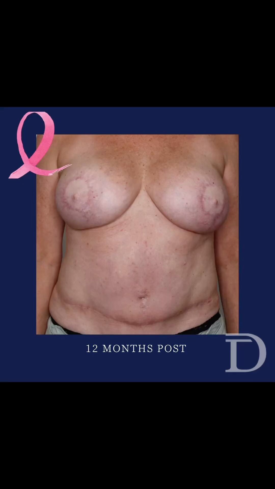 Bilateral DIEP + Nipple Reconstruction 
1. Pre Op 
2. 12 Months Post Op 
- Nipple reconstruction is a minor surgical procedure, generally performed under local anesthesia, to create the ‘mound’/ projection of the nipple. 
- Nipple reconstruction is performed a minimum of 3-4 months post completion of DIEP/ any revision surgery. This allows the tissue to settle/ drop adequately, ensuring correct placement/ symmetry of the nipple position. 
- Areolar/ nipple tattooing is then completed approx 6 months post nipple reconstruction, once scars have settled. 
Surgery Performed by Dr Duncan Taylor (MED0001883464) Specialist Plastic & Reconstructive Surgeon.
🔹 Outcomes achieved in these photos are only relevant to this patient and do not necessarily reflect the results other patients may experience.
🔹There are inherent risks associated with any surgical or invasive procedures. The recovery period varies based on the specific procedure, and individual outcomes will differ.
🔹More information about risks and recovery for each procedure is available on our website www.drduncantaylor.com.au, on the procedure information sheets.
🔹We recommend getting a second opinion from a qualified health practitioner before proceeding.
🔹 This patient gave photo consent. 
#bilateralmastectomy #bilateraldiep #bilateraldiepflap #autologousbreastreconstruction #breastreconstructıon #breastreconstructionawareness #breastreconstructionsurgery #perthbreastreconstruction #breastreconstructionperth #breastcancerperth #perthbreastcancer #nipplereconstruction #nipplereconstructionsurgery #perthplasticsurgeon #plasticsurgeonperth #plasticsurgeryperth #perthplasticsurgery #specialistplasticsurgeon