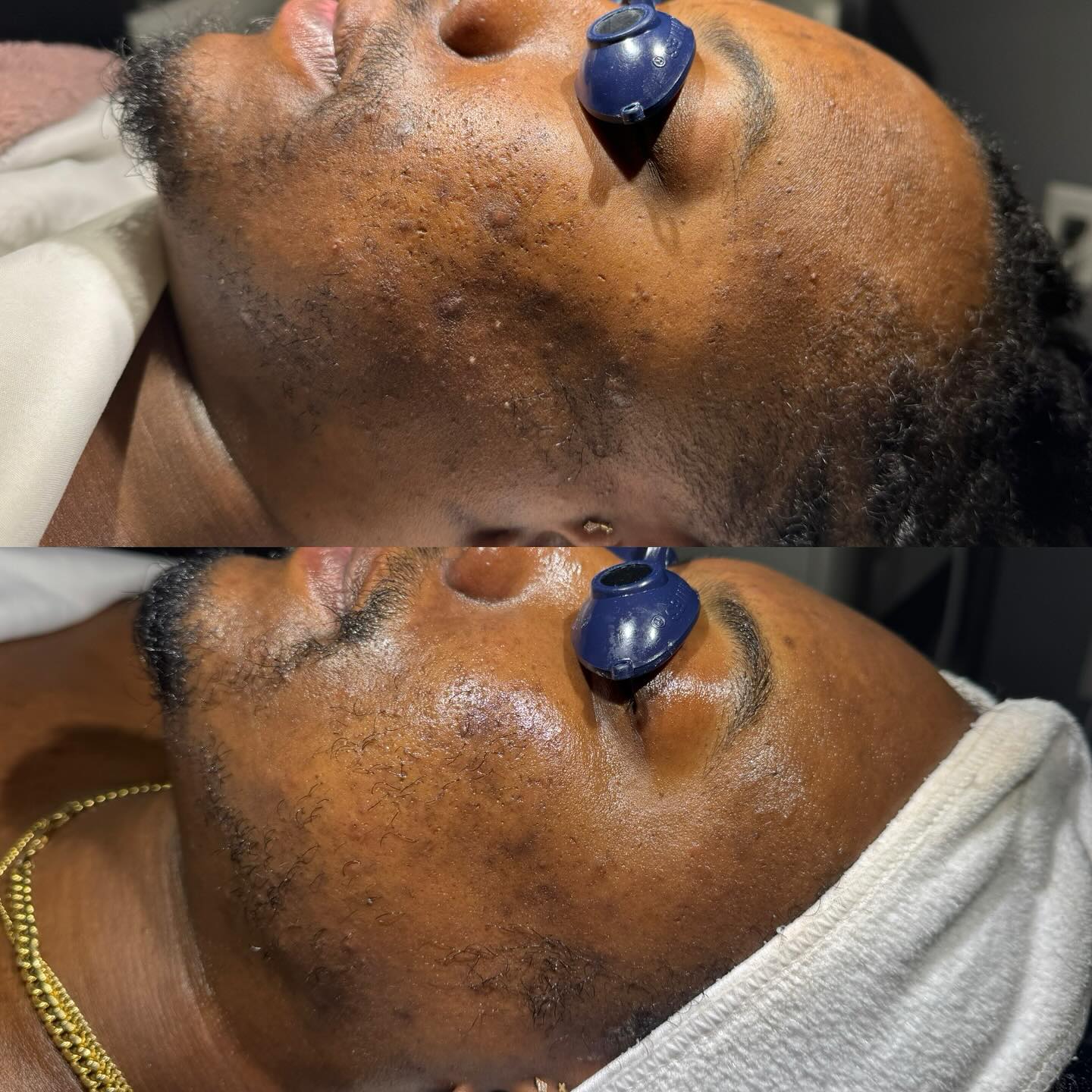 Two facials in and gradually incorporating homecare. Seeing great results so far and can’t wait for the final outcome ✨