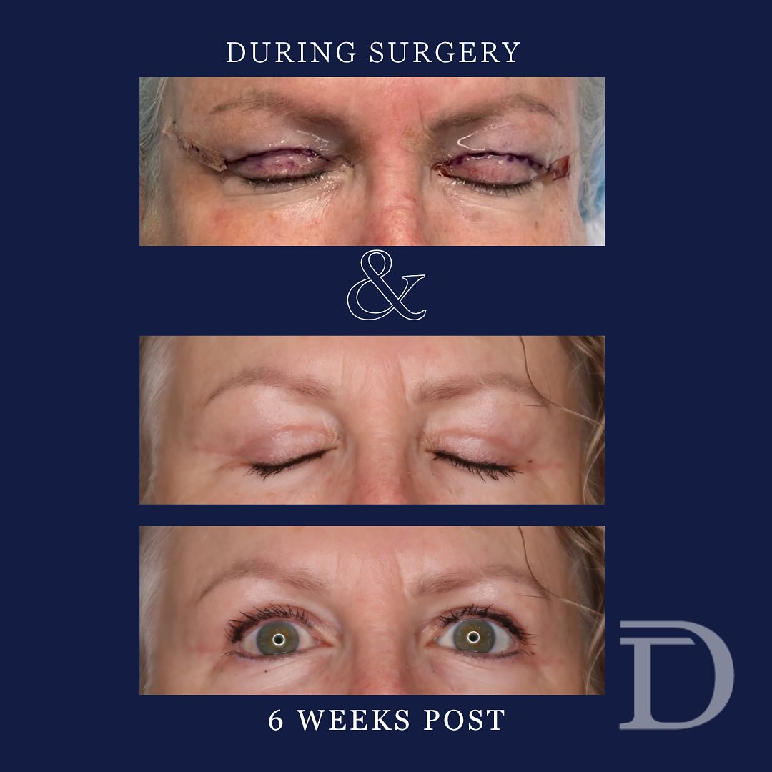 Bilateral Blepharoplasty 
1. Pre Op 
2. 6 Weeks Post 
- Scars take 12-18 months to mature/ fade
Surgery Performed by Dr Duncan Taylor (MED0001883464) Specialist Plastic & Reconstructive Surgeon.
🔹 Outcomes achieved in these photos are only relevant to this patient and do not necessarily reflect the results other patients may experience.
🔹There are inherent risks associated with any surgical or invasive procedures. The recovery period varies based on the specific procedure, and individual outcomes will differ.
🔹More information about risks and recovery for each procedure is available on our website www.drduncantaylor.com.au, on the procedure information sheets.
🔹We recommend getting a second opinion from a qualified health practitioner before proceeding.
🔹 This patient gave photo consent. 
#blepharoplasty #blepharoplastysurgery #blepharoplastyperth #perthblepharoplasty #uppereyelidsurgery #plasticsurgeonperth #perthplasticsurgeon #plasticsurgeryperth #perthplasticsurgery #cosmeticsurgeryperth #perthcosmeticsurgery #specialistplasticsurgeon