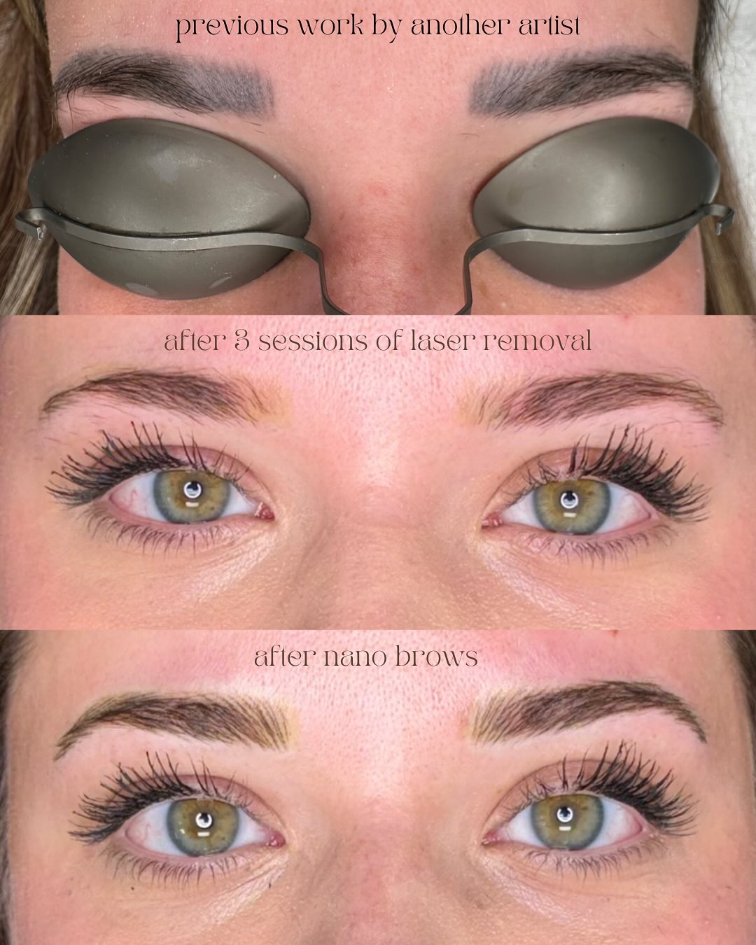 There’s no reason to walk around with bad old Microblading when laser removal exists. I have clients come to me with fully saturated brows like this looking for a “touch up,” but I will always refer them to @jessicalaubach with @prettylittlepores for removal first. If you’re looking to start over with something more natural that will age better over time, Nano Brows might be a good option for you.
#azbrows #aznanobrows #azmicroblading #azmicrobladingremoval #microbladingremoval