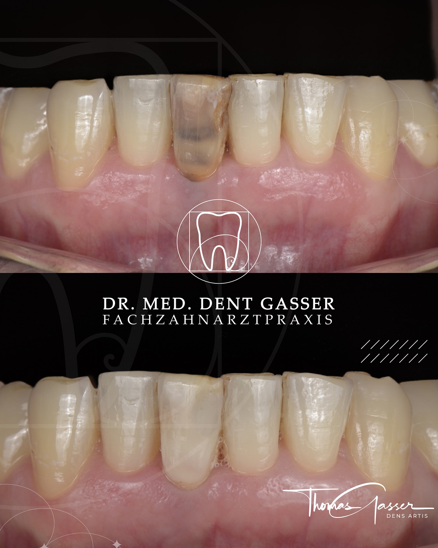 🦷 Ein Zahn, der seine Farbe zurückerhält – dank internem Bleaching
Ein abgestorbener Zahn kann sich dunkel verfärben – oft in störendem Grau oder Schwarz. Das betrifft meist Frontzähne und beeinträchtigt nicht nur das Aussehen, sondern auch das Selbstbewusstsein.
Mit dem internen Bleaching bringen wir diesen Zahn schonend wieder auf natürliche Helligkeit – ganz ohne Überkronung.
➡️ Ziel ist es, die natürliche Zahnfarbe von innen heraus aufzuhellen und den Zahn harmonisch ins Lächeln einzufügen.
➡️ Mit der Walking-Bleach-Technik wird ein spezielles Bleichmittel im Inneren des Zahns platziert, das über mehrere Tage sanft wirkt – völlig schmerzfrei.
💡 Was internes Bleaching für Sie bedeutet:
✔️ Schonende Aufhellung verfärbter Zähne von innen
✔️ Erhalt der natürlichen Zahnsubstanz – kein unnötiges Beschleifen
✔️ Harmonisches, natürliches Lächeln ohne Farbunterschiede
✔️ Schmerzfreie Behandlung mit sichtbarem Effekt in kurzer Zeit
✔️ Nachhaltige Ästhetik – auch bei alten Zahntraumata oder Wurzelbehandlungen
⚠️ Nicht jeder verfärbte Zahn ist für internes Bleaching geeignet – wir prüfen vorab sorgfältig, ob diese Methode in Ihrem Fall die beste Lösung ist.
Ein einziger Zahn kann das gesamte Lächeln verändern – und mit der richtigen Technik holen wir die natürliche Strahlkraft zurück. ✨
📍 Fachzahnarztpraxis Dr. Thomas Gasser
Greifengasse 1, 4058 Basel
📞 +41 61 681 00 10
📧 fachzahnarztpraxis_basel@sso-hin.ch
🌐 www.zahnarztgasser.ch
#InternesBleaching #WalkingBleach #Zahnaufhellung #ÄsthetischeZahnmedizin #ZahnarztBasel #Frontzahnästhetik #LächelnZurück #Minimalinvasiv #ZahnarztDrGasser #Basel