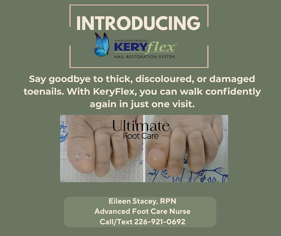 NEW SERVICE ALERT 👣
Guys - I’m super excited to share with you a new service I am now offering at my clinic in St. Marys!
KeryFlex is a nail restoration system that creates a natural-looking, flexible, and durable artificial nail over a damaged toenail. It’s applied in-office by a foot care professional (me 😉) and bonded to your natural nail, allowing it to grow out normally underneath. KeryFlex is perfect for improving the appearance of nails damaged by fungus, injury, or other conditions, giving you instant cosmetic improvement.
If you’re interested in having this service call or text me at 226-921-0692 and we can book you in for an in clinic appointment and get you feeling confident again with your feet. 👣