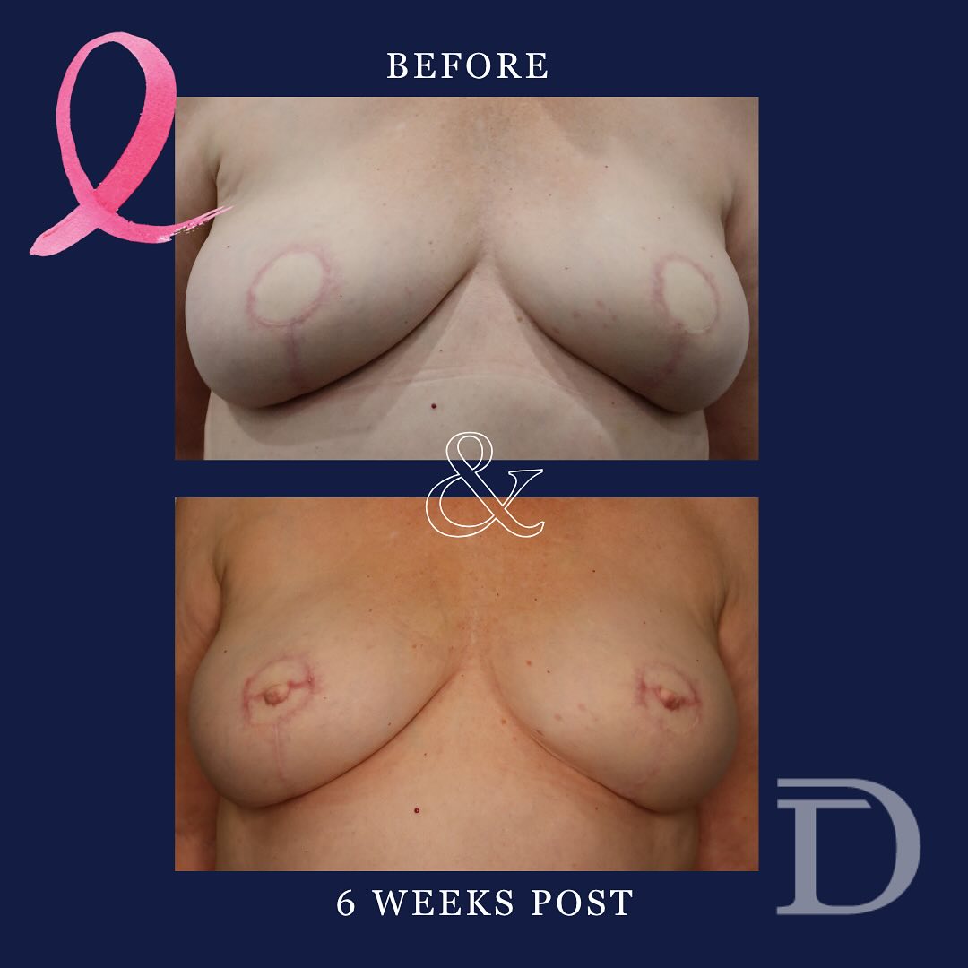 Bilateral Nipple Reconstruction 
- Pre Op 
- 6 Weeks Post 
* Scars take 12-18 months to mature/ fade
* Nipple Reconstruction surgery is generally performed under local anaesthetic * Nipple reconstruction surgery forms the projection of a nipple and the areola & nipple tattooing (completed 6 months post nipple reconstruction) adds the colour/ pigment 
Surgery Performed by Dr Duncan Taylor (MED0001883464) Specialist Plastic & Reconstructive Surgeon.
🔹 Outcomes achieved in these photos are only relevant to this patient and do not necessarily reflect the results other patients may experience.
🔹There are inherent risks associated with any surgical or invasive procedures. The recovery period varies based on the specific procedure, and individual outcomes will differ.
🔹More information about risks and recovery for each procedure is available on our website www.drduncantaylor.com.au, on the procedure information sheets.
🔹We recommend getting a second opinion from a qualified health practitioner before proceeding.
🔹 This patient gave photo consent. 
#nipplereconstruction #nipplereconstructivesurgery #breastcancerperth #perthbreastcancer #breastreconstruction #breastreconstructionperth #perthbreastreconstruction #autologousreconstruction #diepbreastreconstruction #perthplasticsurgeon #plasticsurgeonperth #plasticsurgeryperth #perthplasticsurgery #specialistplasticsurgeon