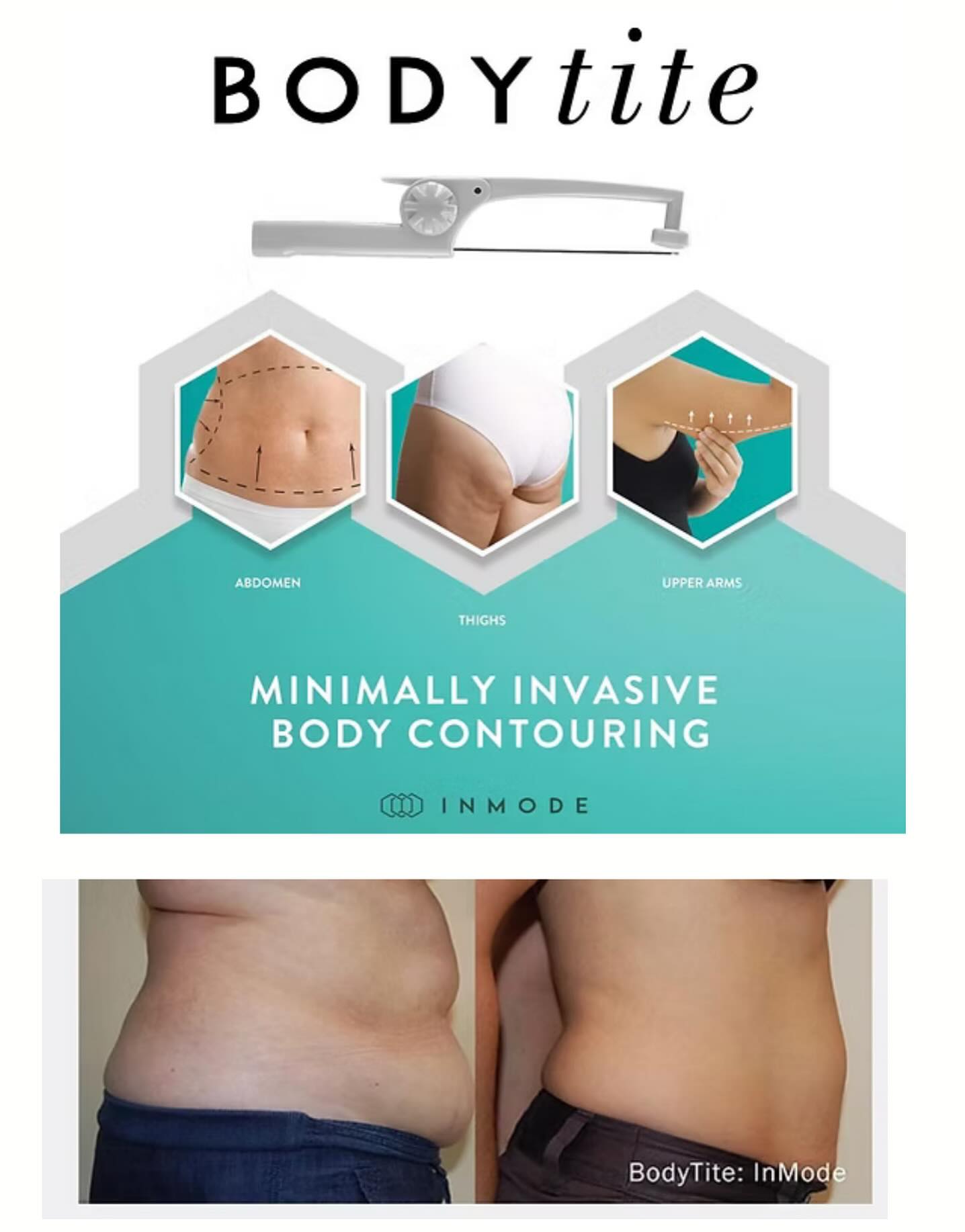 Morpheus BodyTite™: Advanced Skin Tightening & Body Contouring in Winter Park offered at Samano Aesthetics - Complimentary Consults
At Samano Aesthetics Winter Park, under the expert direction of Dr. Samano, patients can now experience the remarkable benefits of Morpheus BodyTite™—a cutting-edge, minimally invasive treatment that pairs radiofrequency (RF) technology with advanced microneedling to contour, tighten, and rejuvenate the body.
Complimentary Consults with Dr. Samano, DM or Call To Schedule!
#BodyTite #MorpheusBodyTite #SkinTightening #BodyContouring #NonSurgicalBodyContouring #RFTechnology #TightenAndTone #bodygoals