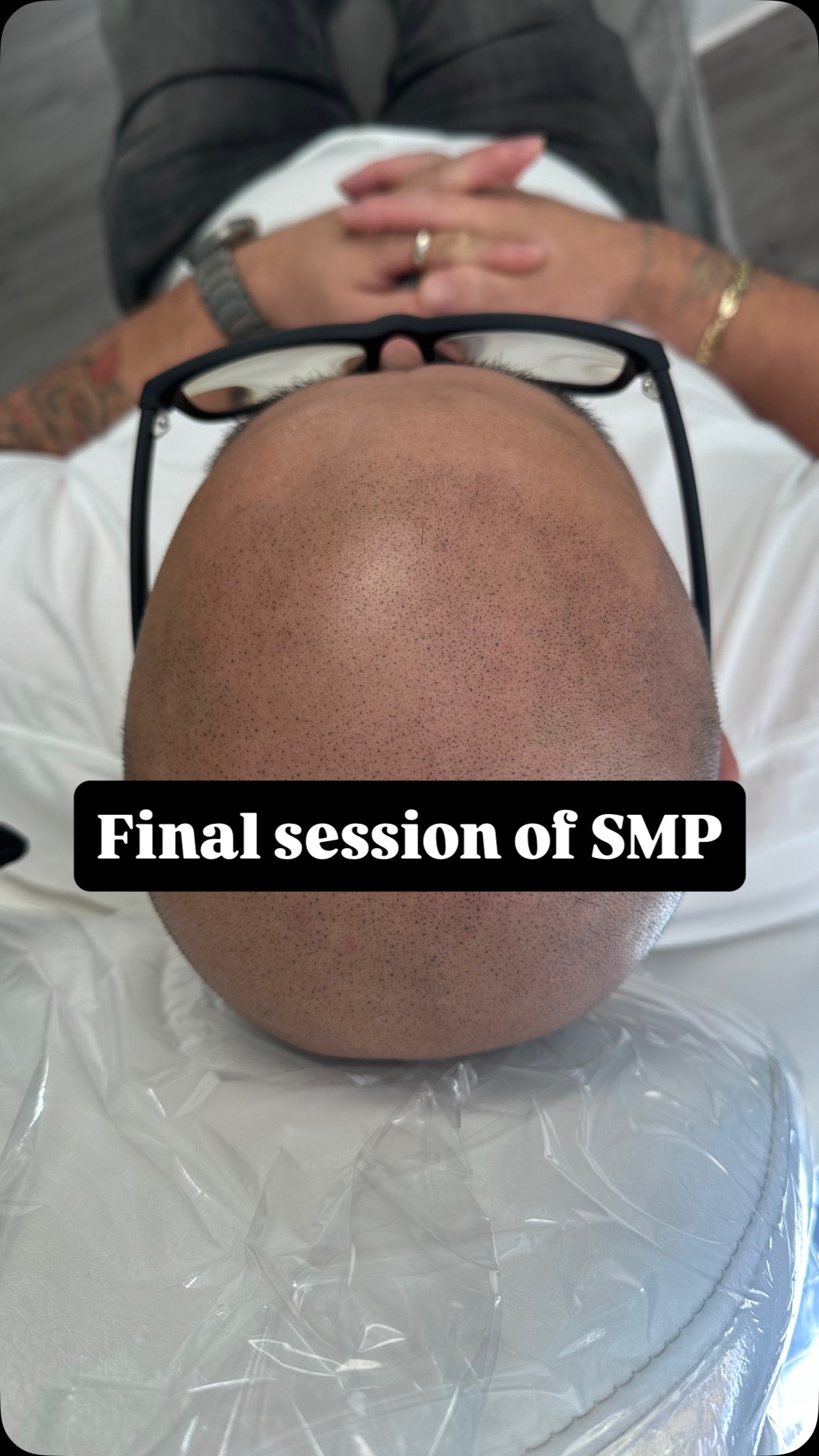 Confidence starts at the top — literally. ✨
Scalp Micropigmentation isn’t just about restoring the look of hair; it’s about restoring you — your confidence, your self-esteem, and the way you show up in the world.
If thinning hair or hair loss has been holding you back, let’s talk. I offer complimentary consultations so you can learn if this life-changing treatment is right for you.
Take the first step toward feeling like yourself again — message me today. 💬
#ScalpMicropigmentation #SMP #HairLossSolution #ConfidenceRestored #HairLossTreatment #ThinningHairSolutions #ScalpMicropigmentationExpert #PermanentHairLossSolution #ConfidenceBoost #HairRestorationWithoutSurgery #HairLossHelp #HairLossConfidence #LookAndFeelYourBest #SMPResults #ScalpTattoo