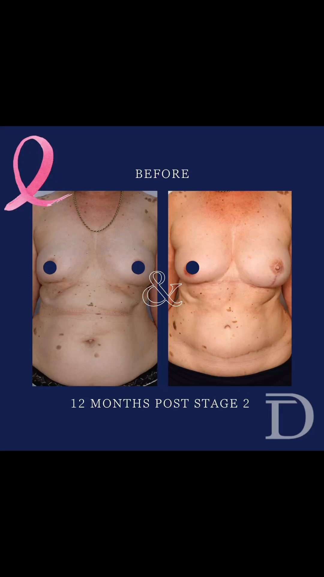 Left Mastectomy + Immediate DIEP Breast Reconstruction 
1. Pre Op 
2. 12 Months Post Stage 2 
- Surgery 1 - Mastectomy + Immediate DIEP Breast  Reconstruction 
- Surgery 2 - Lipomodelling + Nipple Reconstruction 
- Scars take 12-18 months to mature/ fade
- Areola & Nipple Tattooing completed 6 months post nipple reconstruction 
Surgery Performed by Dr Duncan Taylor (MED0001883464) Specialist Plastic & Reconstructive Surgeon.
🔹 Outcomes achieved in these photos are only relevant to this patient and do not necessarily reflect the results other patients may experience.
🔹There are inherent risks associated with any surgical or invasive procedures. The recovery period varies based on the specific procedure, and individual outcomes will differ.
🔹More information about risks and recovery for each procedure is available on our website www.drduncantaylor.com.au, on the procedure information sheets.
🔹We recommend getting a second opinion from a qualified health practitioner before proceeding.
🔹 This patient gave photo consent. 
#specialistplasticsurgeon #perthplasticsurgeon #plasticsurgeonperth #plasticsurgeryperth #perthplasticsurgery #breastreconstructionperth #breastcancerperth #drduncantaylor #perthbreastreconstruction #autologousbreastreconstruction #autologousreconstruction #diepsurgery #diepbreastreconstruction #nipplereconstruction #perthbreastcancer
