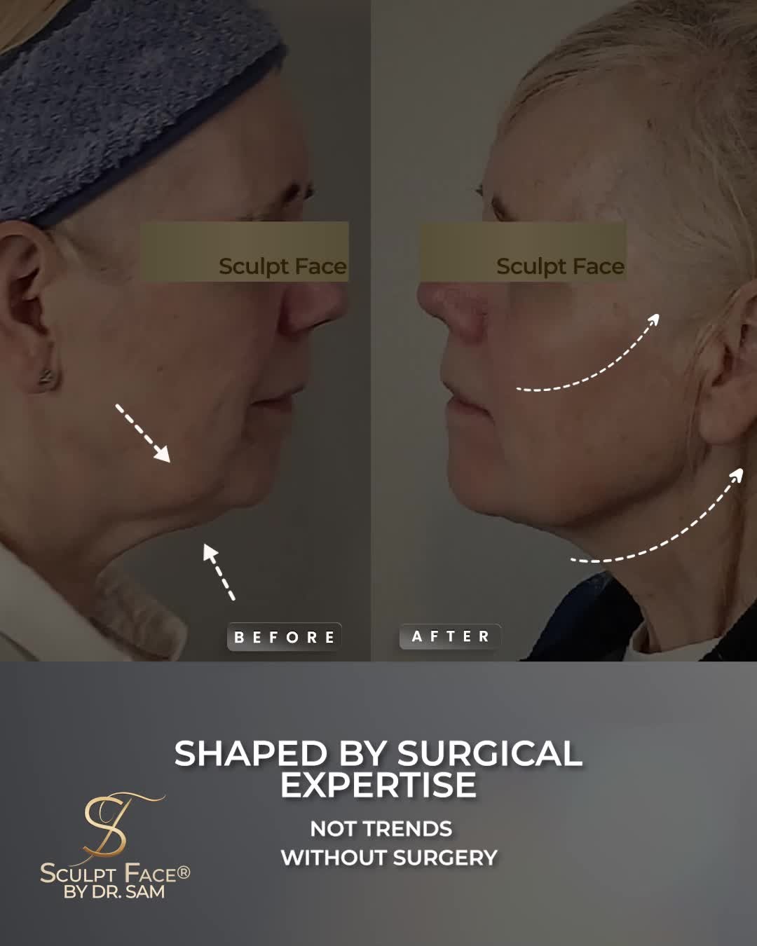 Sculpt Face Real Results:
From only 1 session
✨
Cheeks lifted
Jowls gone
Jawline sculpted
Under chin fat reduced
Neck smoother
Skin that reflects light with ease. ✨
This transformation wasn’t just about restoring structure or redefining contours.
But also about feeling renewed, with confidence that shows in every moment.
At Sculpt Face®, results are shaped through our Sculpt Face Protocol™:
a surgeon-led approach to non-surgical rejuvenation,
designed around your natural features and long-term beauty.
#NoFilter #NoFiller #NoSurgery
Discover how we can help elevate your glow and book a consultation by:
DM us
Call/WhatsApp +447471059239
Email: info@sculptface.co.uk
#SculptFace
#SculptFaceProtocol
#EndoliftUK
#endolift
#endoliftlaser
#endolifting
#endolifttreatment
#endoliftingfacial
#NonSurgicalFacelifts
#SkinRejuvenation
#SkinGoals
#GlowFromWithin
#CollagenBoost
#SkinTightening
#SkinTighteningTreatment
#facialrejuvenation
#laserrejuvenation
#nonsurgical
#aesthetictreatments