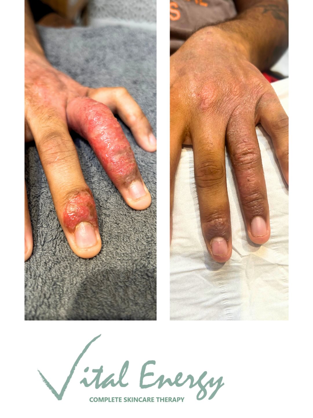 Treatment plan:
@environskincareuk
⭐️Colostrum gel
⭐️Super moisturiser
⭐️Salon treatment DF machine sono with colostrum gel and home use sono handheld device rented from salon .
@advancednutritionprogramme
⭐️Amazing New integrate 28 prebiotic powder
⭐️Skin youth biome one a day.
⭐️Skin omegas 2 a day.
Client is overwhelmed with results it’s given him back his confidence and he’s less conscious of his condition. It was great to see him smile😊.
Treatment start date/First picture taken 10th July 2025 .
After picture taken 18 th August 2025.
#ezcema #environskincare #advancednutritionprogramme
