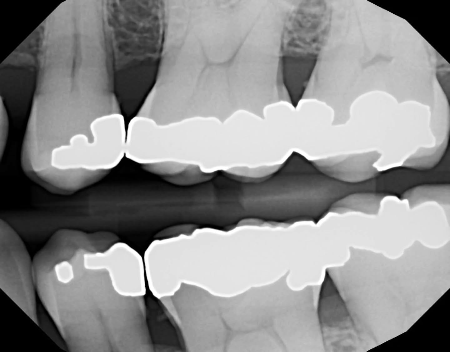 patient presents with a 36 ML cusp fracture, tooth is vital, we struggled with xrays a bit as you can tell, super nice patient, we elected to do a complex restoration for now, he declined an indirect restoration at our office and wants to get a CEREC same day crown as he travels a lot... patient was referred for 36 CEREC 🩵🐚🌊✨️ I PURPOSELY CHOSE THE WRONG SHADE 😆 its so whomever is doing the crown prep can tell whats tooth and what's resin 👀 had to do the filling in stages to get the best contour... it was fun ✨️👍🏼🦷💯🔥
thank u @dr.karangulati for ur help 🙏🏼😍