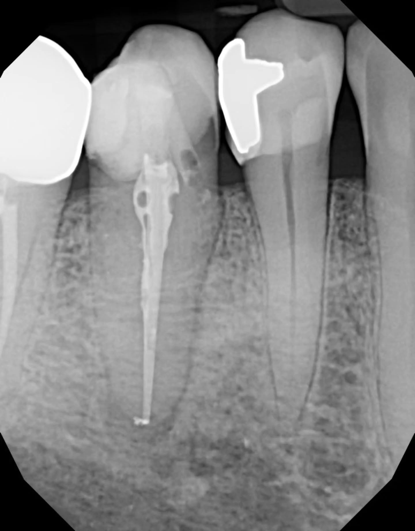 Some teeth don’t like to play fair. 🦷 This #45 was rotated and the access threw me off—I thought I had it, but I ended up with a perforation. Not ideal. Instead of letting that defeat me, I stayed with the case.
The pulp was necrotic, the patient had symptomatic periapical periodontitis, and they needed help. I found the canal, worked to length (24 mm), instrumented, and obturated without further issue. For the perf, I first sealed with Teflon, obturated, removed Teflon, then repaired with DIA Root Repair (MTA), restored with Shofu flowable + Filtek Z250.
Could I have done it differently? Sure. But in dentistry, perfection isn’t always possible—professionalism is. What matters is meeting complications with problem-solving, not shame. This case reminded me that being a dentist isn’t about never slipping; it’s about how you steady your hand after.
life happens 🙃 have a blessed day 👍🏼
✨️🩵🐚🌊🦷🥰
#endodontics #resilienceindentistry #dentistryunfiltered #perforation #perforationrepair