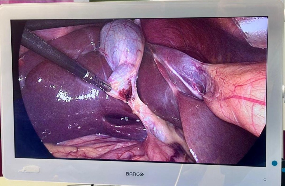 Hoje realizamos uma Colecistectomia por Videolaparoscopia, procedimento seguro e minimamente invasivo para remoção da vesícula biliar.
É importante destacar que pacientes portadores de cálculos na vesícula (colelitíase), mesmo assintomáticos, devem ser avaliados para cirurgia de remoção do órgão. A intervenção é indicada devido aos riscos de complicações graves, como:
👉🏻Colecistite Aguda: inflamação severa da vesícula;
👉🏻Pancreatite Aguda: ocorre quando os cálculos migram para o ducto biliar e afetam o pâncreas, causando inflamação potencialmente grave.
A cirurgia preventiva é a melhor estratégia para evitar emergências e garantir qualidade de vida! Fica a dica!
Você já conhecia esse procedimento? Me conta aqui nos comentários! ⬇️
Dr. José Luis Pantaleão
Cirurgião do Aparelho Digestivo, Cirurgião Bariátrico e Metabólico
CRM 566326 I RQE 24977
#drjosepantaleao #cirurgiabariatrica #bariatrica #cirurgiaaparelhodigestivo #aparelhodigestivo #qualidadedevida #colecistectomia #videolaparoscopia #colelitiase