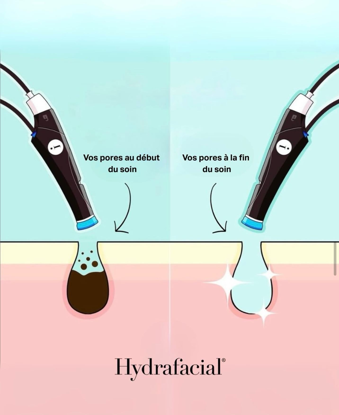 💧 Offrez à votre peau un soin révolutionnaire avec Hydrafacial!
Grâce à sa technologie brevetée Vortex-Fusion®, ce traitement nettoie en profondeur, aspire les impuretés, débouche les pores et réhydrate la peau en un seul geste. Résultat : une peau plus lisse, lumineuse et éclatante dès la première séance. 🩵