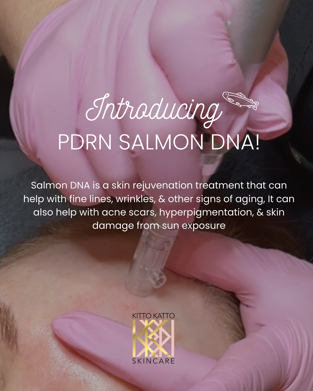 ✨ NEW TREATMENT ALERT ✨
Introducing our newest treatment add-on…
PDRN Salmon DNA 🐟
Add this on to your microneedling appointment for a major boost in smoother & even skin tone, collagen production, hydration, and more! Clients and celebrities are loving the glow from salmon DNA just like Hailey Bieber
DM for more info 💌
#winningskin #salmondna #microneedling #denveresthetician #denverfacial #esthetician #denvermedspa