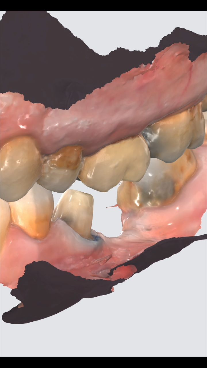 Sometimes you picture a treatment plan that would be so elegant ✨—like in this case, where I envisioned a 35(36)37 bridge after retreatment of 37. In my mind, it would have been such a lovely solution..
After talking through the pros and cons, they ultimately chose to go ahead with a single 35 PFZ crown instead of a bridge.
As much as I might lean toward one option clinically, dentistry is also about partnership and respecting patient choice 🦷💬. My role is to inform, guide, and support—never to dictate.
Have a great day 🐚🩵🌊✨️