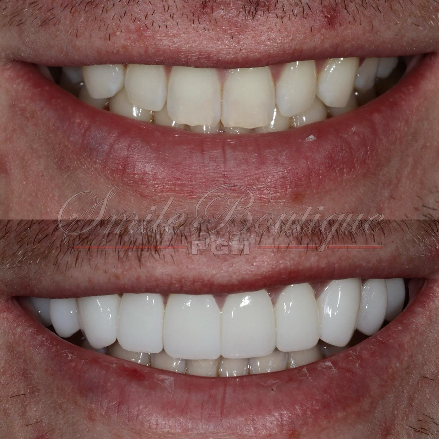 Friday Smile Feature 💫
Two years ago @joeycortese reached out and said “I want a smile like @joeyb_9!” After have reviewed Burrow’s enhanced smile, I’d say now not only Joey has a smile like Joe’s, but it’s better than Joe’s! 🤩
Transformation achieved the following:
Crooked smile ➡️ Balanced Smile
Bucky Teeth ➡️ Flatter Teeth
Asymmetry ➡️ Symmetry
Narrow Smile ➡️ Wider Smile
Small Teeth ➡️ Larger Teeth
Joey C Smile > Joe B Smile
10 Lithium Disilicate veneers later = A happy smiling Joey 🤩
To see what a smile transformation can do for you, book a consult meeting to learn more (link in bio).
#friyay #tgif #fridayvibes #fridaymood #fridayfeature #flashbackfridays #smilemore #smiletransformation #smilemakeover #smiles #smiledesign #cosmetic #cosmeticdentistry #cosmeticdentist #pittsburgh #pittsburghdentist #topdentist #wowsmile #happypatients #joeburrow #celebritysmile #treatyourself #treatyoself #luxurylifestyle #sexysmile #beyou #beconfident #whosnext #alwayssmile #loveit