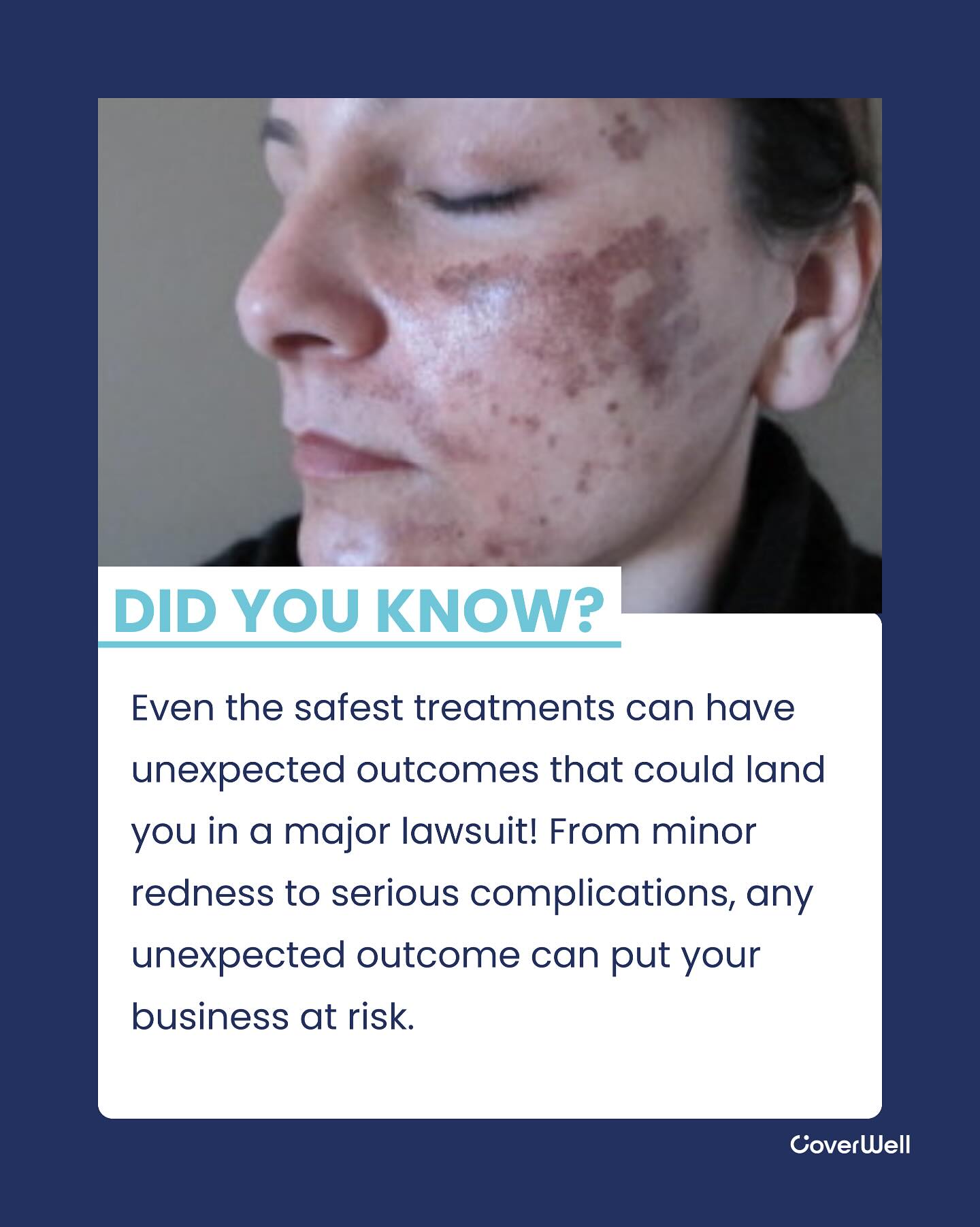 Even when protocols are followed and treatments are performed flawlessly, the unknowns in a patient’s history can trigger complications. And when that happens, your practice is often left holding the financial and legal fallout.
⚠️ Redness, blistering, pigment changes—these can quickly turn into refund demands or lawsuits.
That’s why top practices are turning to CoverWell—a built-in layer of protection that:
✔️ Shields your revenue from no-fault complications
✔️ Provides peace of mind to patients and providers
✔️ Strengthens trust and retention
Don’t wait for a worst-case scenario to hit your business.
CoverWell is your financial safety net when the unexpected happens.
👉 Tap the link in bio to learn how to get started.