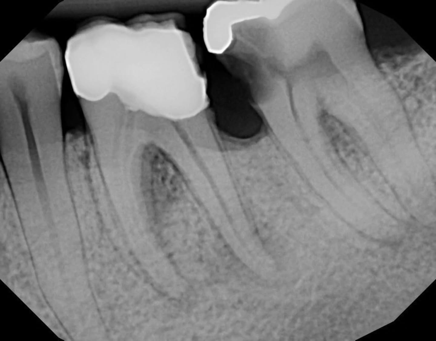 Fun case this morning 🩵
Caries Removal 🔥
DME with Shofu 🤔
37M restored with Filtek Z250 😌
Pulpectomy 👀
Cavit ✌🏼
Patient said that was the best dental experience he had... will come back in few weeks for f/u and final RCT 🙏🏼
It was a very fun appointment 😍👌🏽🌶✨️
Thanks for tuning in 😊