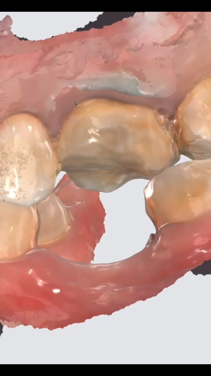 i struggled with the burs during this appointment
mid-prep my diamond bur shed its coat — so dramatic