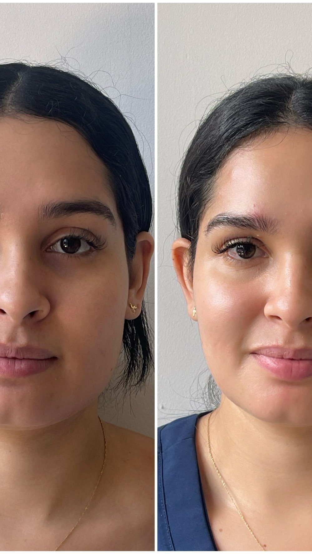 En redes sociales somos víctimas de la inmediatez…
Y eso nos ha llevado a creer que la medicina estética es solamente labios, pómulos y armonización facial. Pero la realidad es que la estética médica va mucho más allá: hablamos de salud de la piel, prevención, envejecimiento saludable, hormonas, alimentación, incluso la microbiota intestinal que también se refleja en tu cara.
Si solo ves la estética como un filtro rápido, te pierdes de entender cómo funciona tu cuerpo, tu piel y tu envejecimiento. Y ahí está la diferencia entre un procedimiento que dura meses… y una estrategia de salud que te acompaña toda la vida
#medicinaestética #rejuvenecimientofacial .