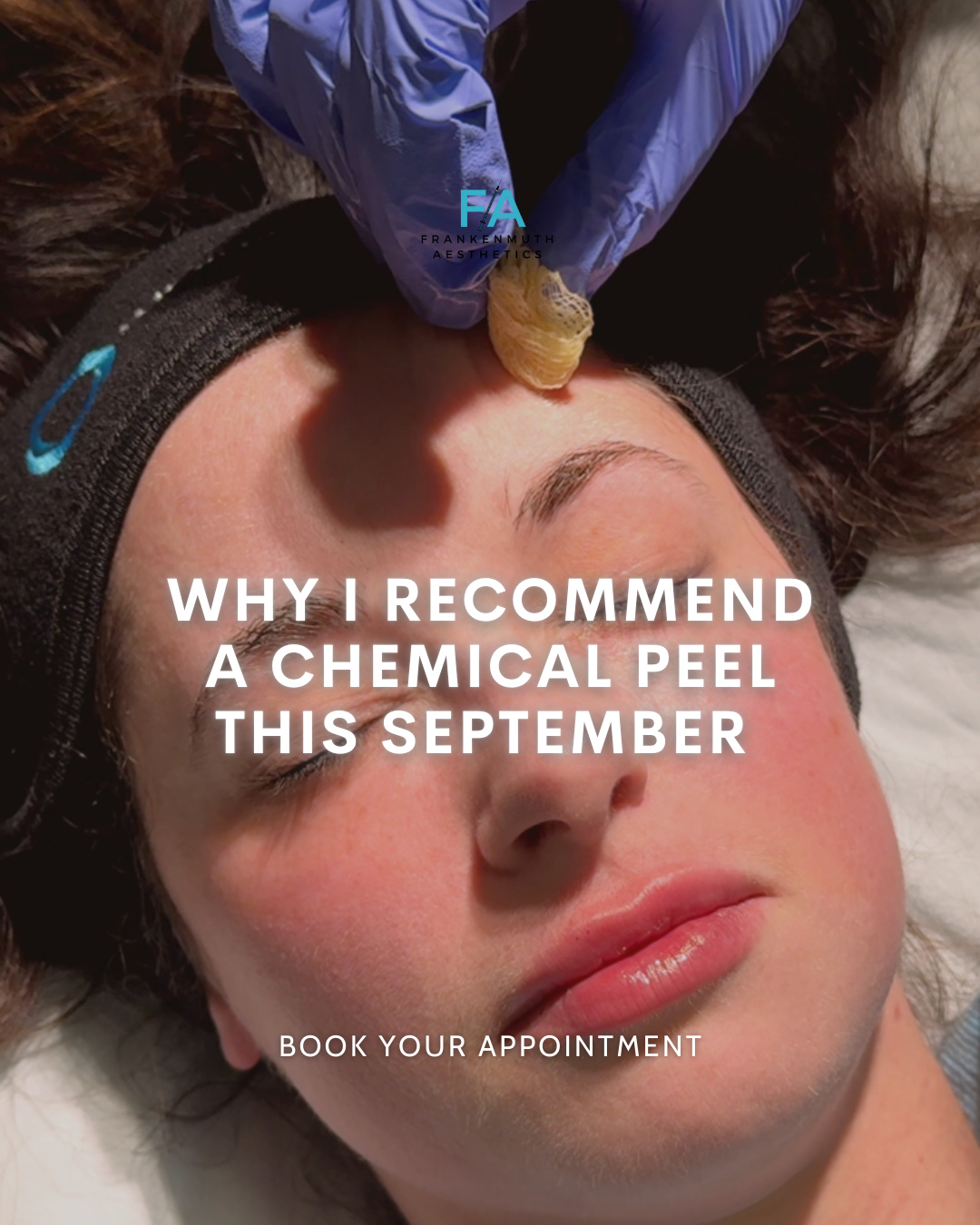 One service I recommend to EVERYONE in September: A chemical peel! ✨
Here’s why I love it: A chemical peel is the ultimate reset for your skin. It gently exfoliates away dead skin cells, improves texture, and gives you that fresh, glowing complexion we all crave. But the real magic? It preps your skin for what’s next—like laser treatments!
Why it’s smart:
A chemical peel clears the way for laser treatments to work even better by removing surface buildup.
It helps even out your skin tone and texture, making laser results even more noticeable.
September is the perfect time to start because cooler weather means less sun exposure, giving your skin the chance to heal and thrive.
Think of it as the ultimate skincare power duo: Peel now, laser later, and glow all season long!
📅 Book your chemical peel today and set your skin up for success. Your future self will thank you!