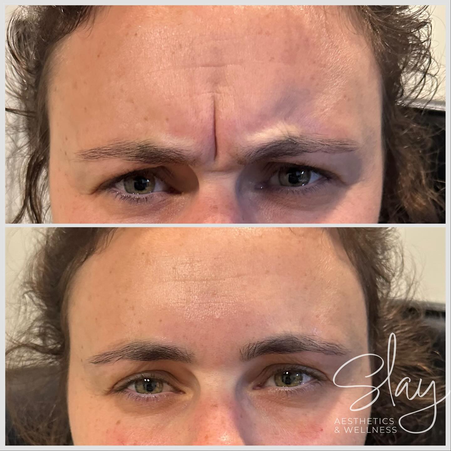 Just a refresh, not a makeover ✨
Botox helps my clients look like the best version of themselves — rested, confident, and radiant. 💉