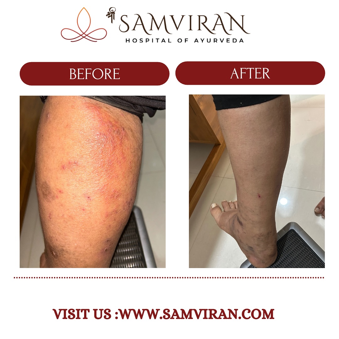 Shree samviran hospital of Ayurveda
Consult Now 7483895926
Get authentic ayurveda treatment near you
.
.
#hubli #dharwad #ayurveda #healing