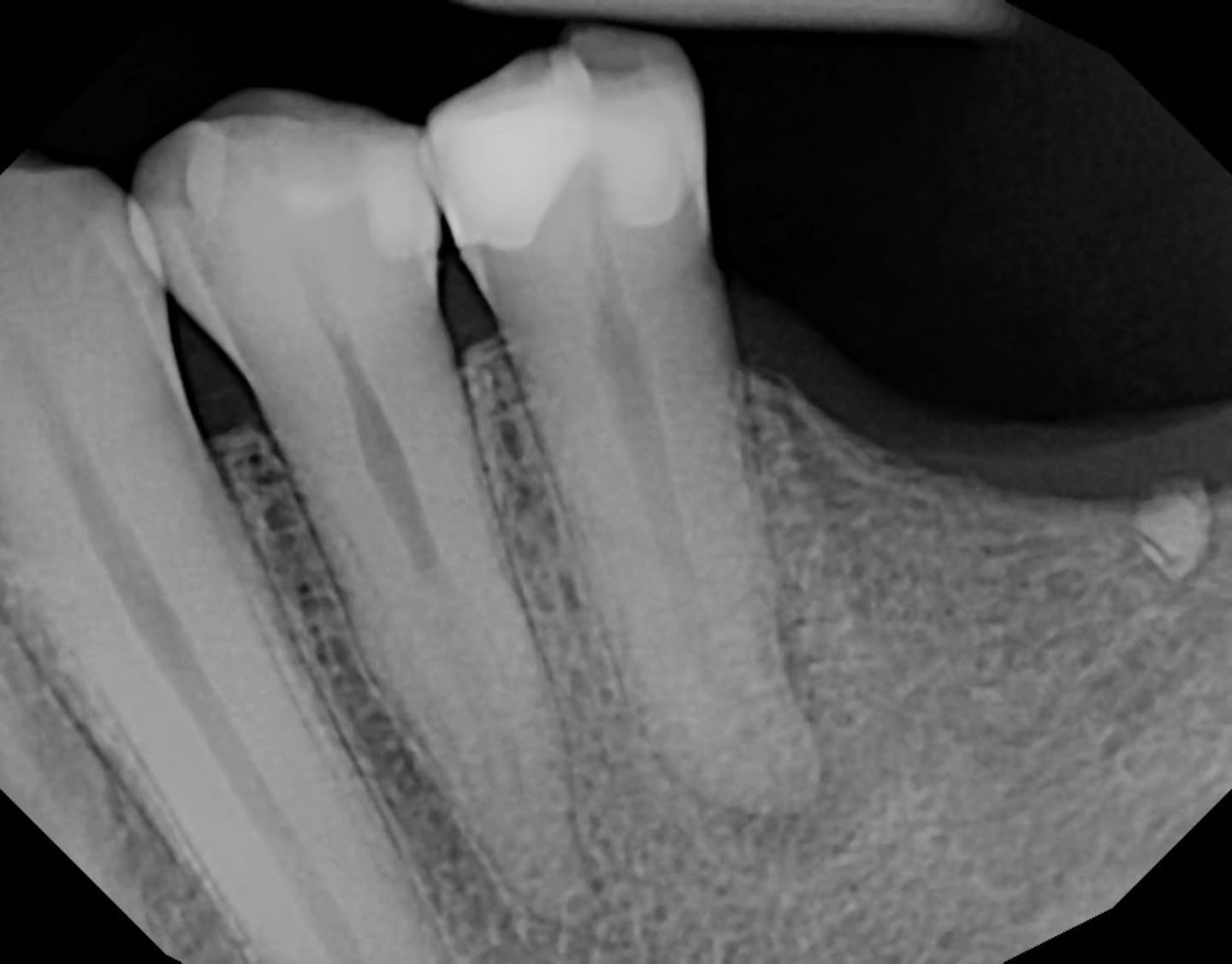 thank u, @drsoniachopra for teaching me about apical gauging, I had a feeling the apex was wide open... I tried different files to get a feel of the apex, then I briefly instrumented the coronal third mostly and took GP down until I got tugback, trimmed it and boom first PA right to working length, while obturating the existing fill came out (glad it did) and we did a new resto and now waiting on crown predetermination 🩵🥰 i even got a lil of that lateral canal 🔥 thank u dr sonia 😍✨️