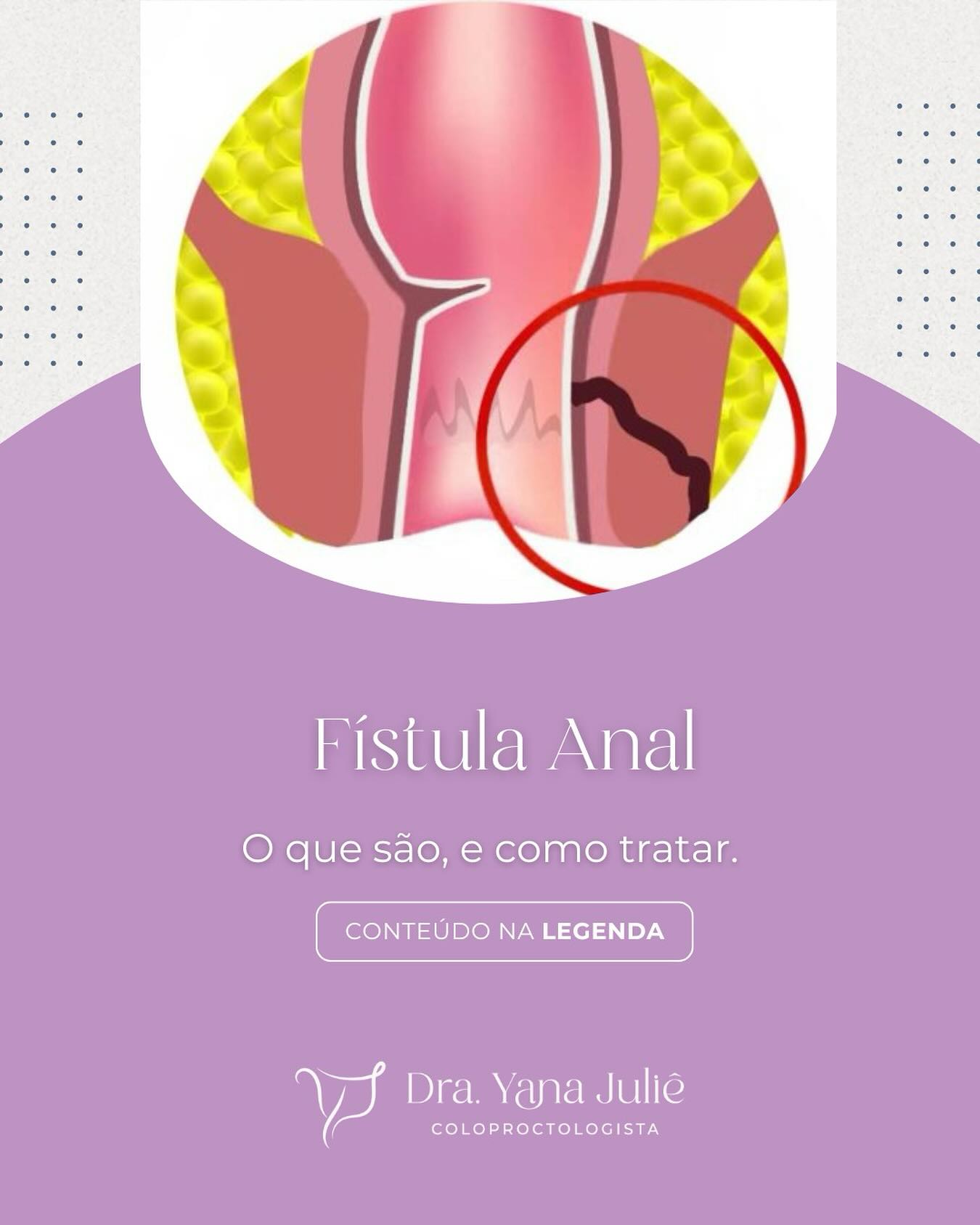 FÍSTULA ANORRETAL
O que são, e como tratar.
Fístulas anorretais nada mais são, do que comunicações do reto ou canal anal com a pele ao redor do ânus, através de um trajeto anormal.
A maioria das fístulas são decorrentes de uma infecção das criptas anais, criando inicialmente um abscesso, e evoluindo para a formação de um trajeto fistuloso, ou seja, a fístula anal.
No entanto, está não é a única causa. As fístulas podem ser consequência de:
- Doença Inflamatória Intestinai (Doença de Crohn);
- Traumas;
- Câncer de Canal Anal e Reto;
- Alterações Anais Pós-radioterapia; e,
- Tuberculose Anal.
O tratamento é CIRÚRGICO, e o tipo de cirurgia depende da localização, gravidade e do tipo de fístula, se envolve ou não a musculatura.
Procure um proctologista e não deixe que o desconforto da Fístula Anal atrapalhe seu dia-a-dia.
*** Este conteúdo possui caráter informativo.
Dra. Yana Juliê Perondi
Coloproctologista
CRM: 29717 || RQE 27567
#Procrologista #proctochapeco #fistulaanal #sangramentoanal #cuidado