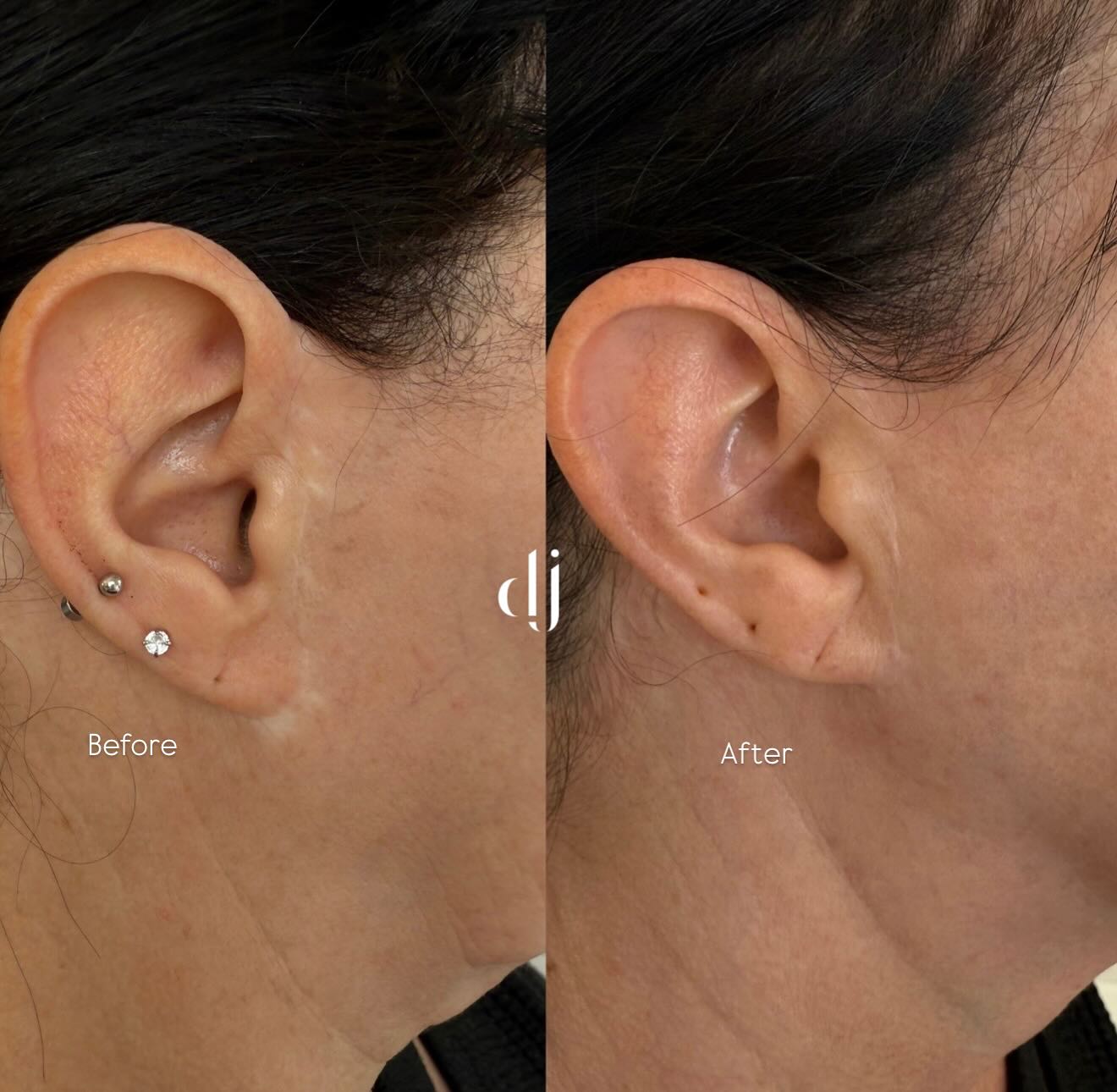 Now you see the scars now you dont! 👀
Scar Revision treatment bespoke medical needling packages and camouflage tattoo
Showing that even old scars can be turned around. The skin is the biggest organ she listens and she renews 🤎 These scars are from a face lift surgery.
#scarrevision #scartreatment #scarremoval #scarcamouflage #scarremovaluk #scarrevisionuk #camouflagemakeup #camouflagemakeup #camoflaugetattoo #pmu #pmumakepermanentemakeup #pmuspecialist #pmuartist #pmuacademy