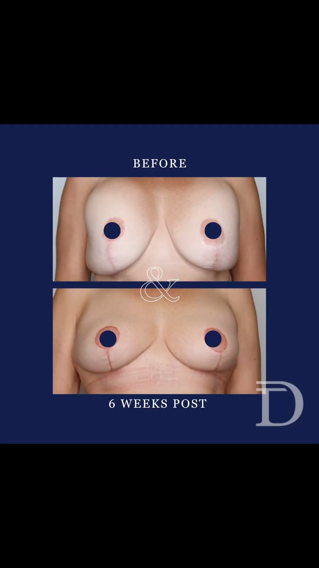 Explant + Total Capsulectomy +  Mastopexy (Breast Lift)
1. Pre Op 
2. 6 Weeks Post Op 
- Scars take 12-18 months to mature/ fade
Surgery Performed by Dr Duncan Taylor (MED0001883464) Specialist Plastic & Reconstructive Surgeon.
🔹 Outcomes achieved in these photos are only relevant to this patient and do not necessarily reflect the results other patients may experience.
🔹There are inherent risks associated with any surgical or invasive procedures. The recovery period varies based on the specific procedure, and individual outcomes will differ.
🔹More information about risks and recovery for each procedure is available on our website www.drduncantaylor.com.au, on the procedure information sheets.
🔹We recommend getting a second opinion from a qualified health practitioner before proceeding.
🔹 This patient gave photo consent. 
#specialistplasticsurgeon #perthplasticsurgeon #plasticsurgeonperth #plasticsurgeryperth #perthplasticsurgery #breastreconstructionperth #cosmeticsurgeryperth #perthbreastreconstruction #explantsurgery #breastimplantsperth #implantremovalsurgery #breastliftperth #perthbreastlift #perthcosmeticsurgery #perthbreastsurgery #breastsurgeryperth