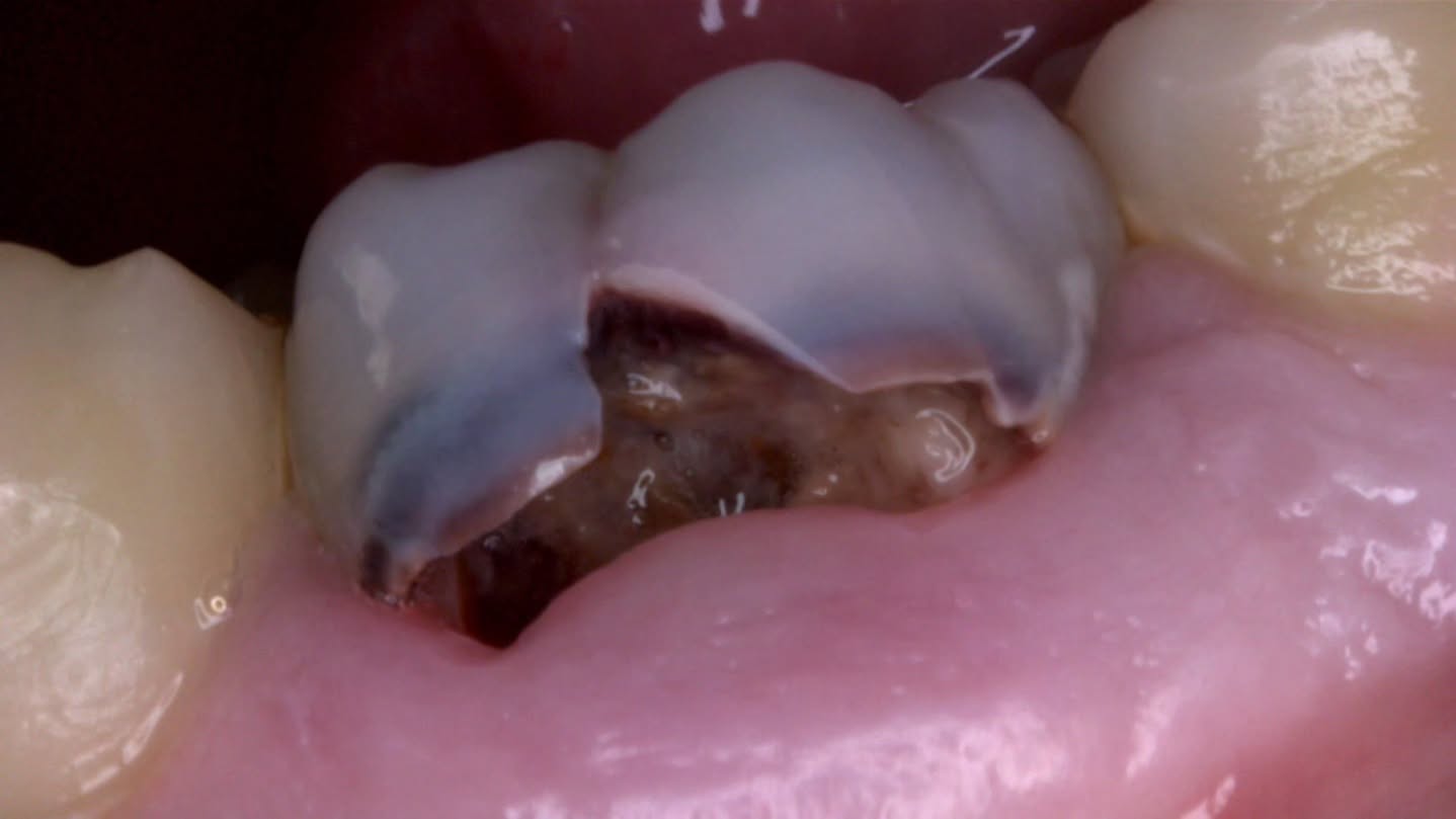 tuff cases today 😵💫😝 this was my 9 am case ✨️✌🏼 PIECE OF CAKE 🎂✨️👍🏼 will come back for RCT.. mesial and distal roots are however, not a piece of cake 😳😩 stay tuned 📻
used @gcamericainc fuji 2 LC 🔥