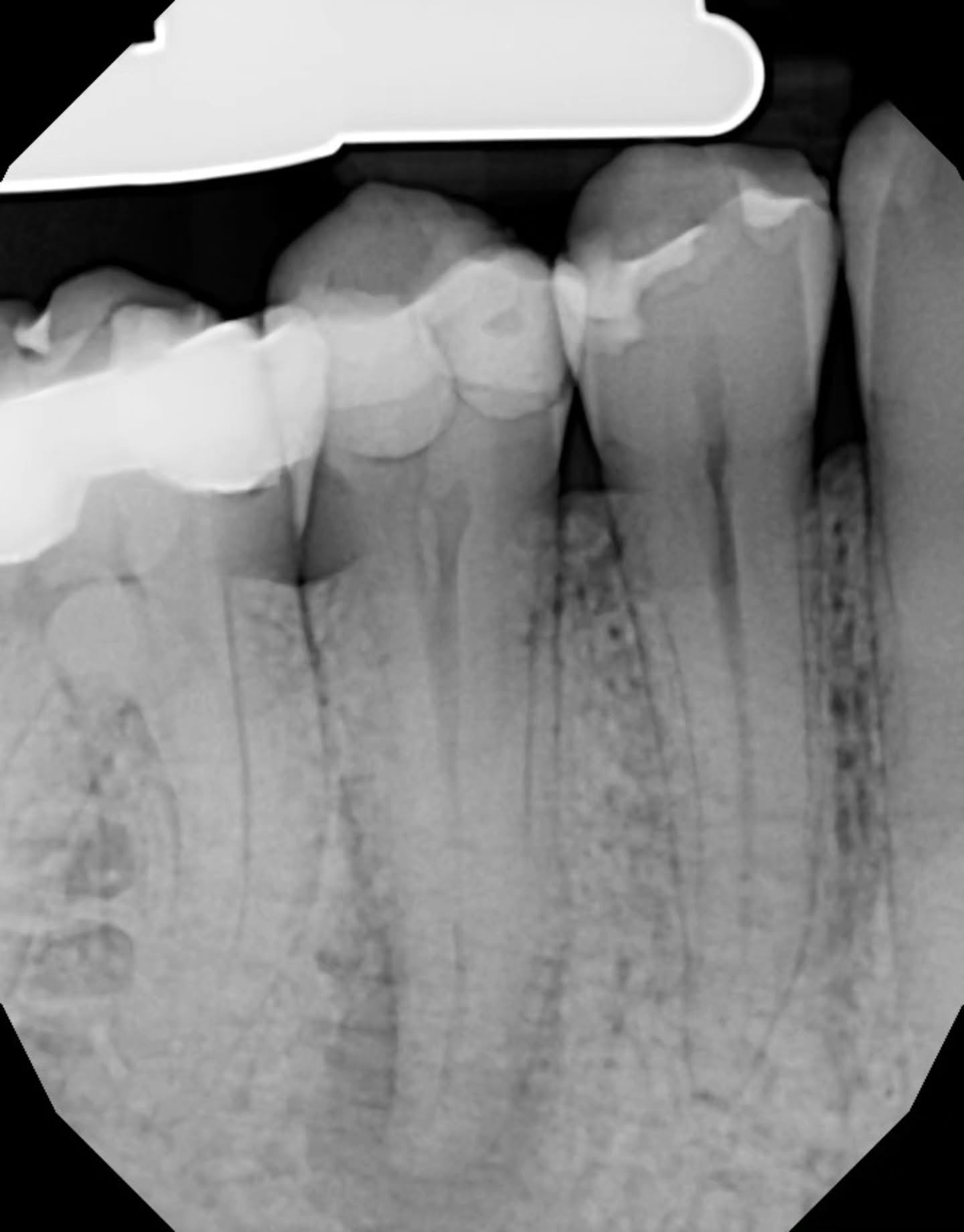 pretty happy with this RCT.. could we have instrumented that second canal? not sure 😕 but I got sealer in there 😅🤓 pretty cool case this morning ✨️🔥👍🏼
comments? 🤗😙