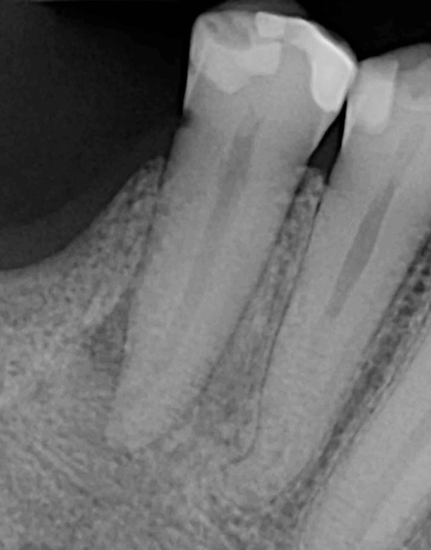 boom 💥 2 lateral canals 👌🏽😙
obturation used to be THE worst for me.. u gotta pump that GP 🤓 thank u @drsoniachopra and @drbrettgilbert for making me a better clinician 🔥✨️