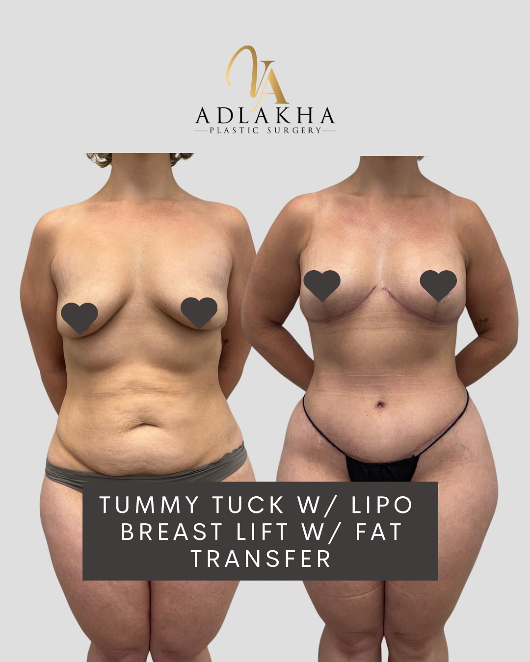 🤱A Mommy Makeover is a comprehensive body contouring surgery that includes personalized combination of procedures designed to address the physical changes that occur during and after pregnancy and breastfeeding.
🧚🏼♀️It most commonly includes a tummy tuck, breast lift and/or augmentation, and liposuction - but the approach is tailored to each patient’s unique goals and anatomy.
👆🏼This mommy makeover = Tummy Tuck + Liposuction Flanks & Lower Back + Breast Lift with Autologous fat transfer
✅ Abdominoplasty: Removal of excess skin and tightening of the abdominal wall musculature
✅ Liposuction: Flank and back contouring for improved waist definition
✅ Mastopexy: Lifting, tightening the skin envelope and reshaping of the breasts without implants
✅ Small volume fat transfer to breasts to enhance shape and volume without use of breast implants
🎯 Customized plan
🛡️ Safety first
📍 Board-certified results
🔎Results shown in early healing phase. Scars will continue to fade over time with proper aftercare and scar management protocol.
🪡Individualized surgical planning for optimal symmetry and proportion.
To book your consultation you can:
📞Call 234 458 2010
📲DM @dr.vidhiadlakha
📧Email us info@adlakhaplasticsurgery.com
💻Visit the website in my bio
.
.
.
This is an actual patient of Dr. Vidhi Adlakha. All photos are released with consent. Please do not use or distribute without permission.
#Abdominoplasty #BreastLift #Liposuction #BodyContour #TummyTuckResults #Mastopexy #PlasticSurgeon #BeforeAndAfter
#Adlakhaaesthetics #fattransfer #adlakhaplasticsurgery #reels #transformationtuesday #weightloss #bodycontouring #mommymakeover