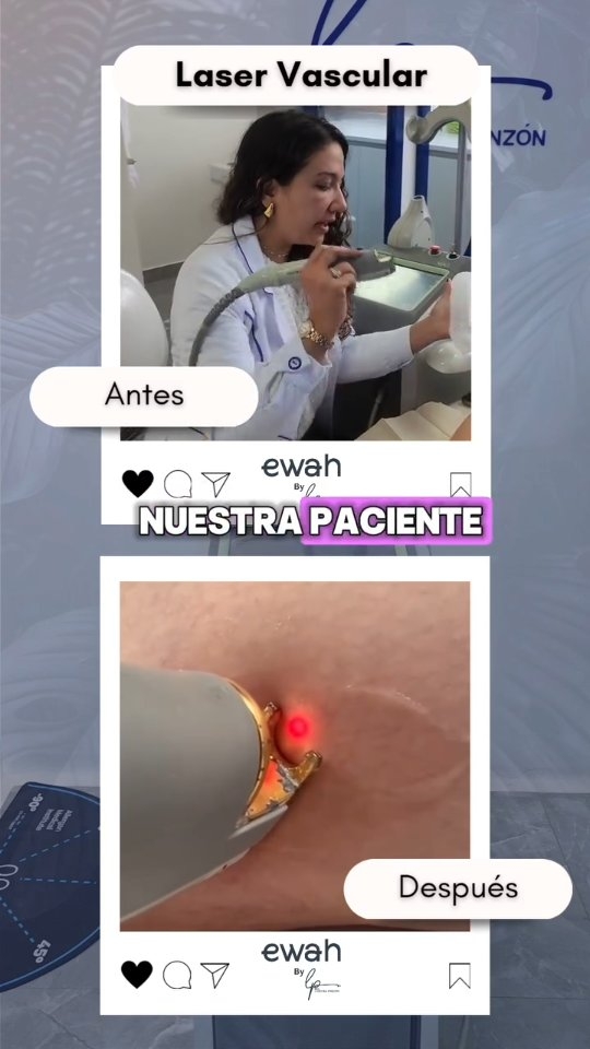 Si buscas reducir las arañitas vasculares en piernas, nariz o rostro, no dudes en consultar con nosotros.
En EWAH By Dra. Lorena Pinzon tenemos el láser vascular de vanguardia en Colombia. Así obtendrás resultados rápidos y duraderos.
Mira en tiempo real como este tratamiento transforma la apariencia de las arañitas vasculares.
No lo pienses más y agenda con nosotros.
Info en la Bio.
#cuidadodelapiel #laservascular #laservascularcolombia #laservascularbogota #arañitasvasculares #arañitasvascularesbogota
#arañitasvascularescolombia
#varices #tratamientovarices #tratamientovaricesbogota #varicesbogota