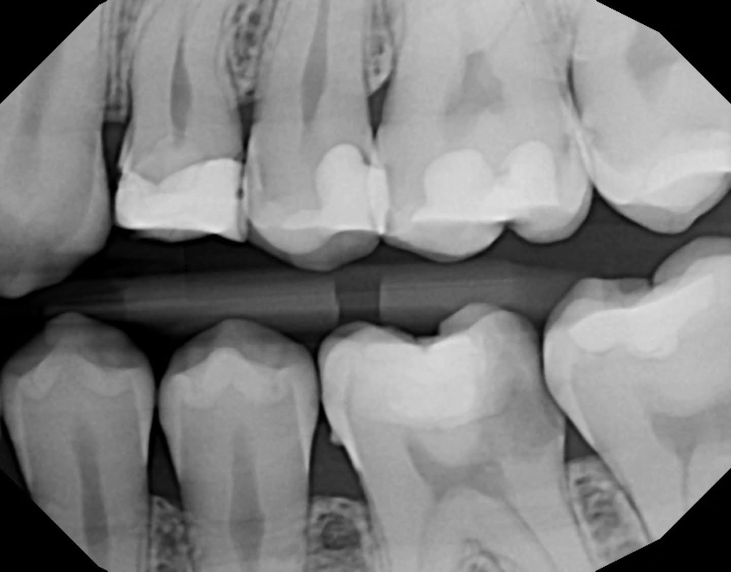 🦷 Case: 36 with irreversible pulpitis. After caries excavation, I placed Ultracal + PTFE in the chamber, restored the distal wall, and sealed the occlusal with Cavit. Looks like a 4-canal RCT ahead. Stay tuned..
💡 Matrix tip for those deep D boxes:
Use a thick, sturdy matrix (not dead soft) so it doesn’t collapse under pressure.
Wedge firmly — sometimes I’ll wrap the wedge in Teflon or add tiny PTFE plugs in the DB/DL corners to help seal the line angles. Pre-wedging can be helpful but I always forget..
Once the ring is on, burnish the heck out of it for a tight seal.
Don’t be afraid to try multiple bands — today it took me 6–7 before one sat right.
If the teeth are tight, a quick pass with a flame bur at the gingival margin can create just enough clearance for the band.
These cases take patience and persistence. It’s not about being a hero — just step by step, stubborn attention to seal, and a sturdy matrix. Hard mode, but doable 😅