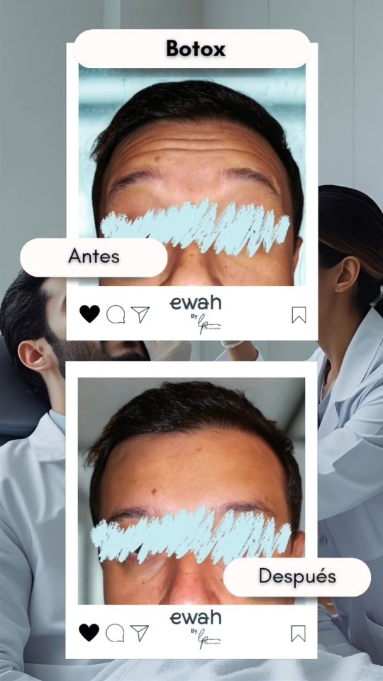 POV: Finalmente entiendes por qué TODOS hablan del Botox 💉
CASOOS REALES
ANTES:
😔 Líneas marcadas en frente
😤 Entrecejo con "número 11" permanente
😣 Patas de gallo profundas
📸 Evitaba fotos sin filtro
DESPUÉS (2 semanas):
✨ Piel lisa tipo filtro de Instagram
😊 Expresión relajada y natural
👁️ Mirada juvenil y descansada
📸 Selfies con confianza
LA CIENCIA DETRÁS:
El Botox relaja temporalmente los músculos que causan las arrugas dinámicas. No "paraliza" - solo suaviza. Por eso se ve tan natural cuando está bien aplicado.
💡 DATO: El 92% de nuestras pacientes repiten el tratamiento porque:
- Los resultados son evidentes
- No duele (en serio)
- Dura 4-6 meses
- Previene arrugas futuras
INVERSIÓN: Desde $500.000 por zona
(Tercio superior completo en este caso: $1.300.000)
📌 Guarda este post si estás considerando Botox
💬 Comenta "INFO" para precios personalizados
🔄 Comparte con quien necesita ver esto
Dra. Lorena Pinzón - 15+ años creando resultados naturales
#BotoxEducation #BeforeAfterBotox #AntesDespuesBotox #BotoxExplained #RealPatient #CasoReal #TransformacionReal #BotoxResults #ToxinaBotulínica #MedicinaEstéticaBogotá #FacialRejuvenation #AntiAgingTreatment #NaturalBotox #ExpertInjector #DraLorenaPinzon #MedicalAesthetics #BotoxBeforeAfter #WrinkleTreatment #FacialAesthetics #ConfidenceBooster #AgingGracefully #PreventativeBotox #SkinGoals #HealthyAging #ColombianBeauty #AestheticMedicine #PatientStories #RealTransformation #NoFilterNeeded #BotoxJourney