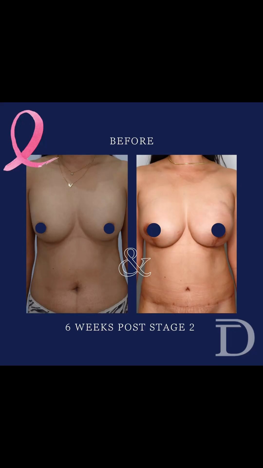 Bilateral DIEP Breast Reconstruction 
1. Pre Op 
2. 6 Weeks Post Op Stage 2 
- Stage 1 - Bilateral nipple sparing mastectomy + immediate DIEP reconstruction 
- Stage 2 - Removal of monitoring skin paddles + lipomodelling 
- Scars take 12-18 months to mature/ fade
Surgery Performed by Dr Duncan Taylor (MED0001883464) Specialist Plastic & Reconstructive Surgeon.
🔹 Outcomes achieved in these photos are only relevant to this patient and do not necessarily reflect the results other patients may experience.
🔹There are inherent risks associated with any surgical or invasive procedures. The recovery period varies based on the specific procedure, and individual outcomes will differ.
🔹More information about risks and recovery for each procedure is available on our website www.drduncantaylor.com.au, on the procedure information sheets.
🔹We recommend getting a second opinion from a qualified health practitioner before proceeding.
🔹 This patient gave photo consent. 
#specialistplasticsurgeon #perthplasticsurgeon #plasticsurgeonperth #plasticsurgeryperth #perthplasticsurgery #breastreconstructionperth #breastcancerperth #perthbreastreconstruction #breastsurgeryperth #diepbreastreconstruction #diepsurgery #autologousreconstruction