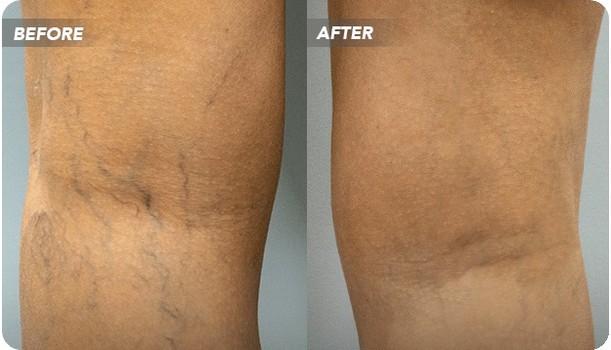 ✨ Real Results: Laser Vein Removal
Visible veins on the face or legs can make many people feel self-conscious — but with advanced laser vein removal, clearer, more even skin is within reach.
This treatment uses targeted laser energy to safely collapse unwanted spider veins, broken capillaries, and vascular lesions on areas like the legs, cheeks, nose, and chin. Over time, the treated veins are naturally reabsorbed by the body, revealing smoother, more uniform skin tone.
Laser vein removal is a minimally invasive, no-downtime procedure that delivers precise, effective results with each session. Most clients notice visible improvement after just a few treatments.
If you’ve been struggling with visible leg veins or facial redness, this treatment can help restore your confidence and comfort in your skin.
📅 Book your consultation today to see if laser vein removal is right for you.
#lasertreatment #laserveinremival #transformationtuesdays #beforeandafter #veinremoval #skincaregoals #skincareroutine #skinhealth #medspa #medspalife #medspamagic #myrtlebeach #myrtlebeachwellness