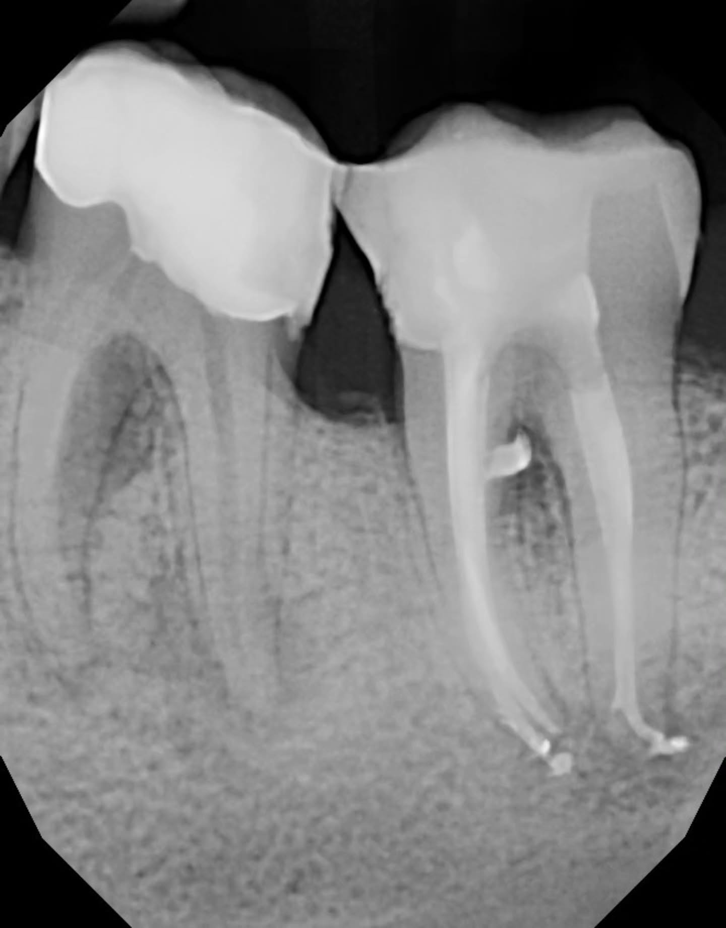 🦷 37 Root Canal Case
During the cone fit radiograph, we noticed a small radiopaque speck near the MB canal orifice — looks suspiciously like a tiny file tip 🤔 (less than 1 mm). Everything was measured properly, so I’m not sure what it is, but always interesting to see!..
Irrigation went beautifully and obturation filled some nice lateral canals ✨
Overall, I’d rate this one a 7.85/10 — solid case, but always room to improve.
If you have thoughts about that radiopaque spot, please drop a comment — this is how we all get better together 🤗🙏🏼
#endodontics #rootcanaltreatment #dentistry #dentaleducation #rct #learningdentistrytogether