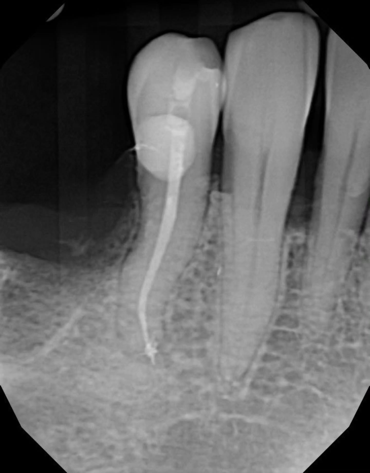 🤓✨️➰️ my occlusal access was too small for my comp packer 😮💨😅 but otherwise not bad not bad 👌🏽😊