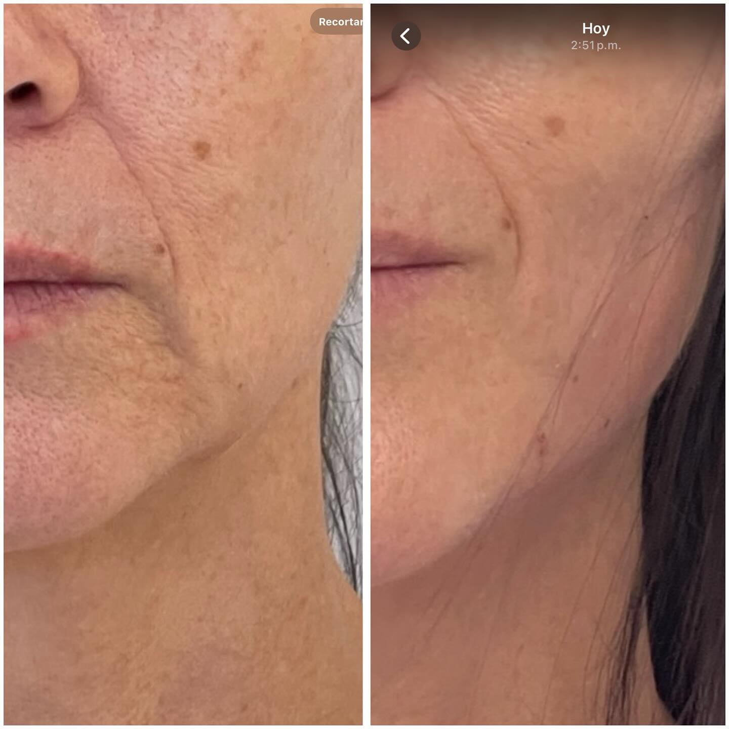 Los surcos nasogenianos (o pliegues nasolabiales) son esas líneas que van desde la nariz hasta la comisura de los labios 👄
Con el tiempo se marcan más por la pérdida de colágeno, grasa y soporte facial.
💉 Actualmente no se busca rellenarlos directamente, sino mejorar el soporte facial para lograr resultados más naturales y armoniosos 🤍✨