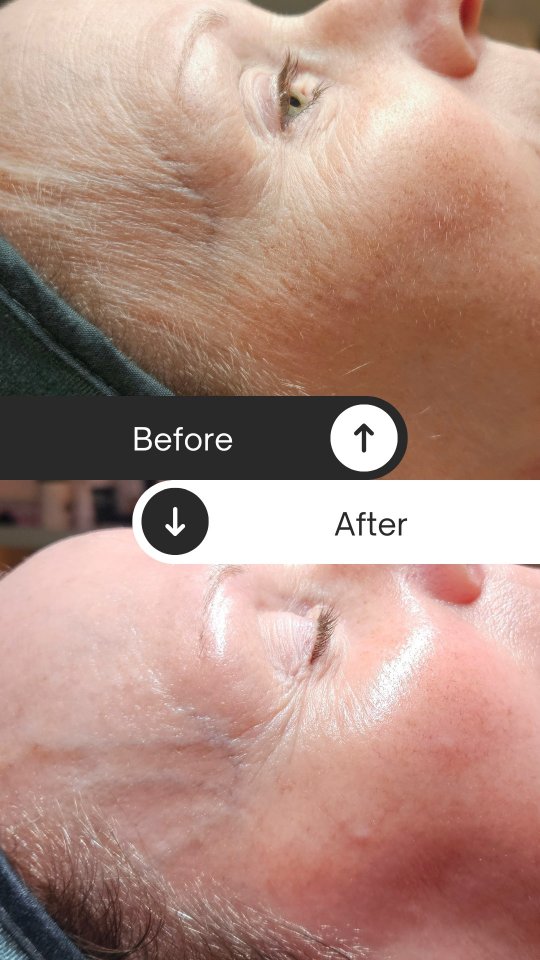 Want the results of a chemical peel without the downtime? Try the SWiCH treatment. Instead of triggering repair by causing damage, it fuels the skin's own energy system to support regeneration at the cellular level. This means no sheet peeling and no downtime, visible results after just one treatment.
.
#Thecosmeticworkshop #kensingtonmd #circadia #chemicalpeel #DMVSkincare