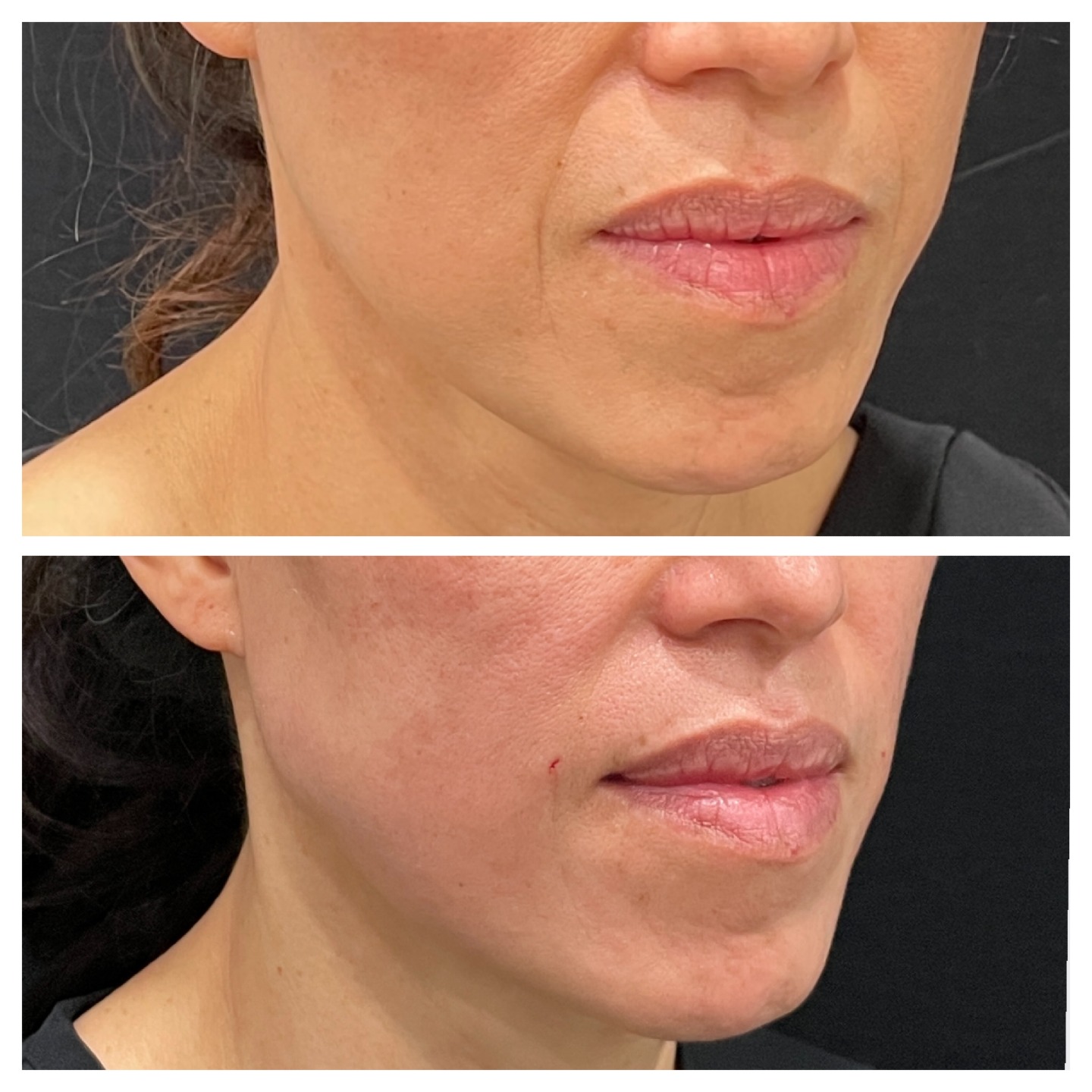 ✨ Lift. Tighten. Restore — Naturally with PDO Threads.
PDO thread lifts are a non-surgical solution for sagging skin, designed to gently lift, tighten, and stimulate collagen for a more youthful, refreshed appearance.
Using medical-grade dissolvable threads, this treatment encourages your body’s own collagen production — improving firmness, elasticity, and skin texture over time.
Common treatment areas include:
💫 Lower face and jawline
💫 Cheeks and midface
💫 Neck and brows
Unlike traditional facelift surgery, PDO threads offer minimal downtime and natural-looking results that continue to improve as collagen rebuilds beneath the skin.
Whether you’re noticing early signs of aging or simply want a subtle lift, PDO threads help you achieve a smoother, more contoured appearance — without surgery.
📅 Book your consultation today to learn if PDO threads are the right fit for your skin goals.
#transformationtuesdays #pdothreadlift #pdothreads #facelift #medspa #medspalife #medspamagic #myrtlebeach #myrtlebeachwellness #mindbodyspirit #beautytips #beforeandafter #skintightening #esthetics