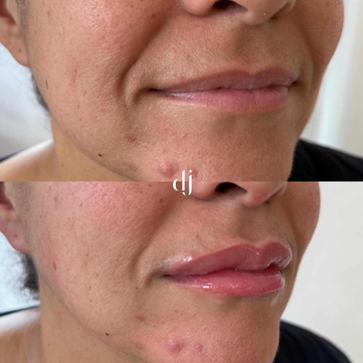 Lip Blush - Before & After
This wanted a natural look to enhance and define her lips adding a touch of fullness without fillers
Pictures are straight from treatment
Booking your consultation in the bio 🔝
#lipblushtattoo #lipblushmasterclass #lipblushtraining
