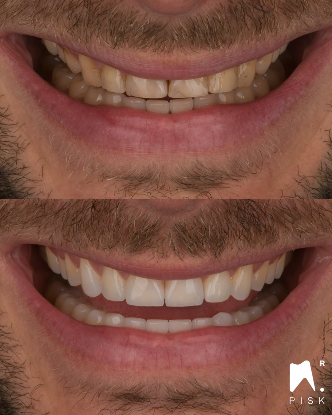 You want to learn more about this technique ? Go on « formation dentaire hdf »
https://formationdentairehdf.com/formations-au-centre/
🇫🇷
Chez ce patient, d’anciennes restaurations composites avaient été posées afin de fermer des diastèmes maxillaires.
Présence également d’une usure d’origine érosive.
Au préalable nous avons fait un traitement par aligneurs français.
Un traitement global a été réalisé par stratification et injection sur toutes les dents, à l’exception des incisives mandibulaires.
Dans ce cas, une stratification simplifiée a été choisie avec uniquement le G-ænial Universal Injectable (GUI).
Stratification simple : dentine et émail.
Matériau utilisé : GUI OA2, JE
⸻
🇬🇧
This patient presented with large composite restorations placed to close maxillary diastemas.
There was also erosive wear.
First, we used aligners.
A full-mouth treatment was performed with stratification and injection on all teeth, except for the mandibular incisors.
In this case, a simplified stratification was chosen using only G-ænial Universal Injectable (GUI).
Simple layering: dentin and enamel.
Material used: GUI OA2, JE
#dentisterieesthétique #estheticdentistry #composite #injectiontechnique #smiledesign #GUI #GC #stratification #resincomposite #drpisk