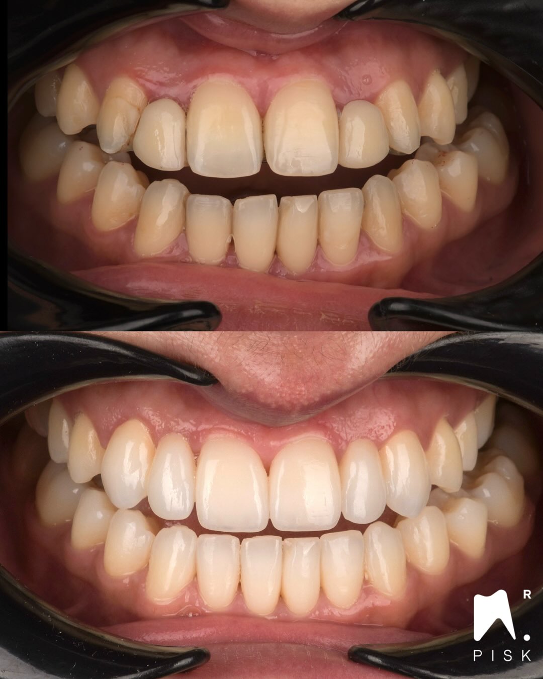 🇫🇷
Patiente présentant d’anciens bridges métalliques de type Maryland pour remplacer les incisives latérales.
Plan de traitement :
1. Dépose des bridges existants
2. Traitement orthodontique pour améliorer l’occlusion et le positionnement dentaire
3. Ovalisation de l’espace latéral à l’aide du dernier aligneur
4. Réalisation des restaurations céramiques par le prothésiste Guillaume Sabathier
Les restaurations comprennent :
• 2 facettes sur 11 et 21
• 2 couronnes cantilever sur canines remplaçant les incisives latérales
👉 Point clé : tout l’émail des canines a été intégralement préservé.
⸻
🇬🇧
Patient with old metallic Maryland bridges replacing a lateral incisor.
Treatment plan:
1. Removal of the existing bridges
2. Orthodontic treatment to improve occlusion and tooth positioning
3. Ovalization of the lateral space using the last aligner
4. Ceramic restorations by dental technician Guillaume Sabathier
Final restorations:
• 2 veneers on 11 and 21
• 2 cantilever crowns on canines replacing lateral incisors
👉 Key point: the enamel of the canines was fully preserved.
⸻
#DentisterieEsthétique #EstheticDentistry #SmileDesign #MarylandBridge #Cantilever #ConservativeDentistry #MinimalInvasive #Veneers #CeramicRestorations #DrPisk
