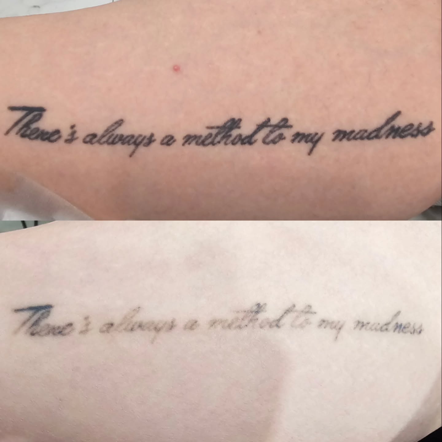 Three sessions with our Pico laser and the difference is incredible! Smooth fading, no scarring, just results.